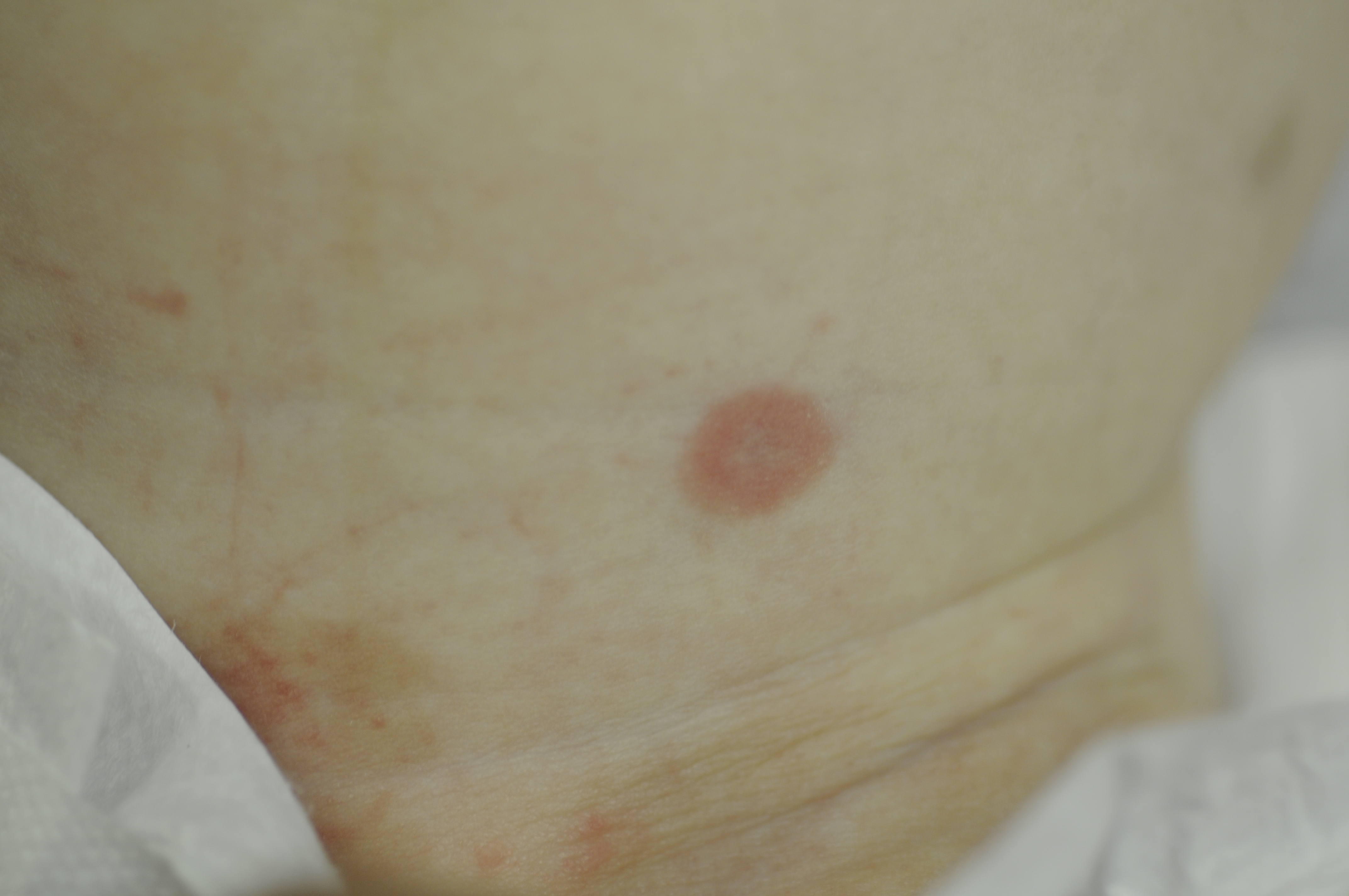 Neonatal Lupus 1a