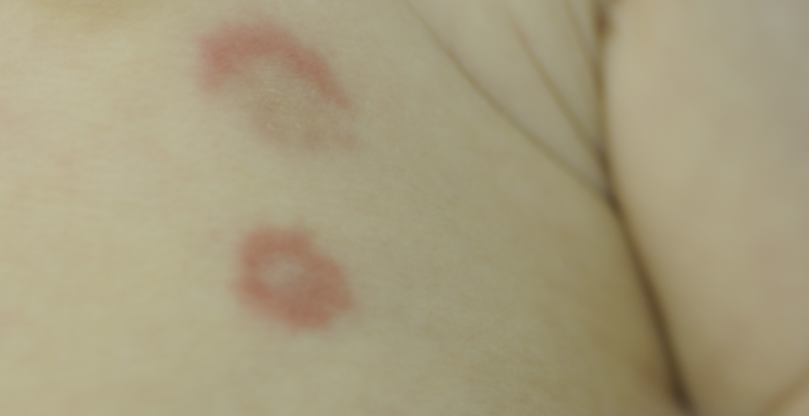 Neonatal Lupus 1b