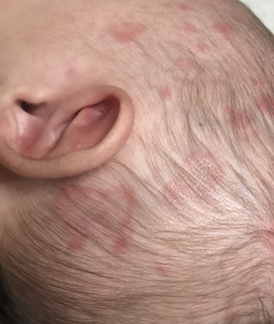 Neonatal Lupus 2a