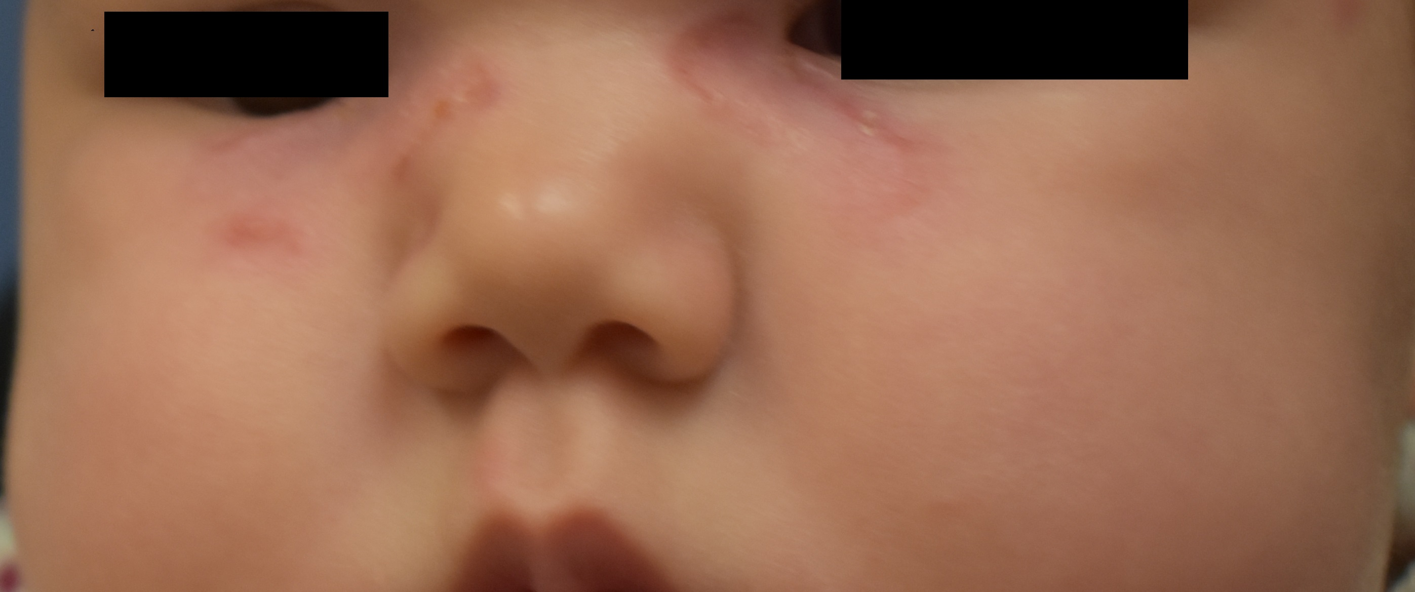 Neonatal Lupus 2b