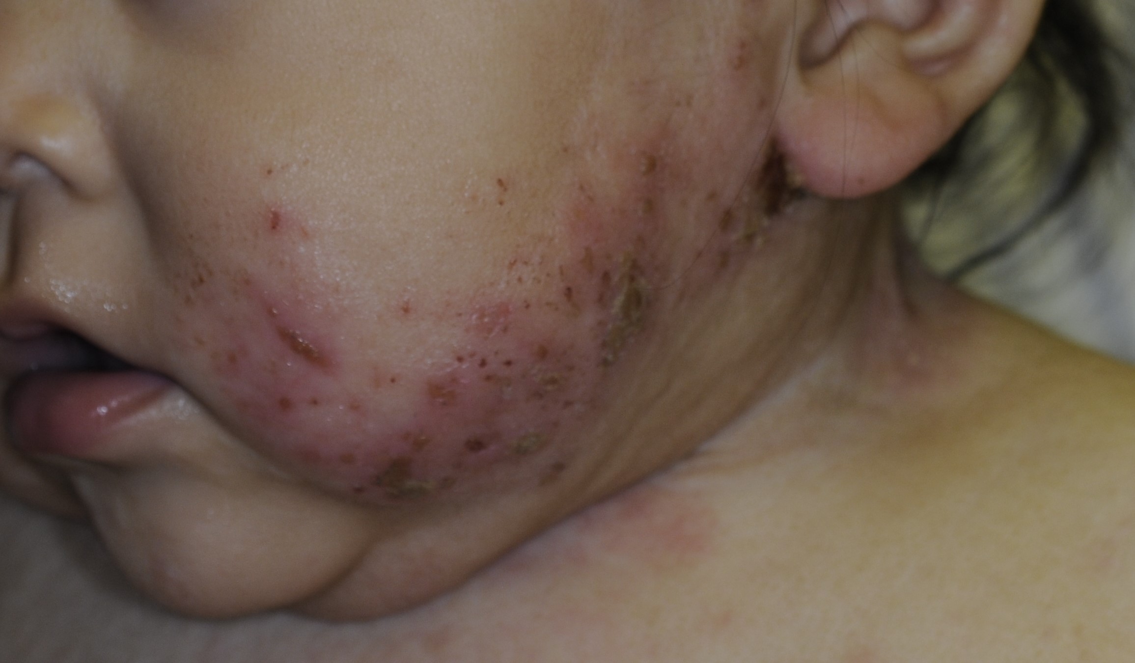 Neonatal Lupus 3a