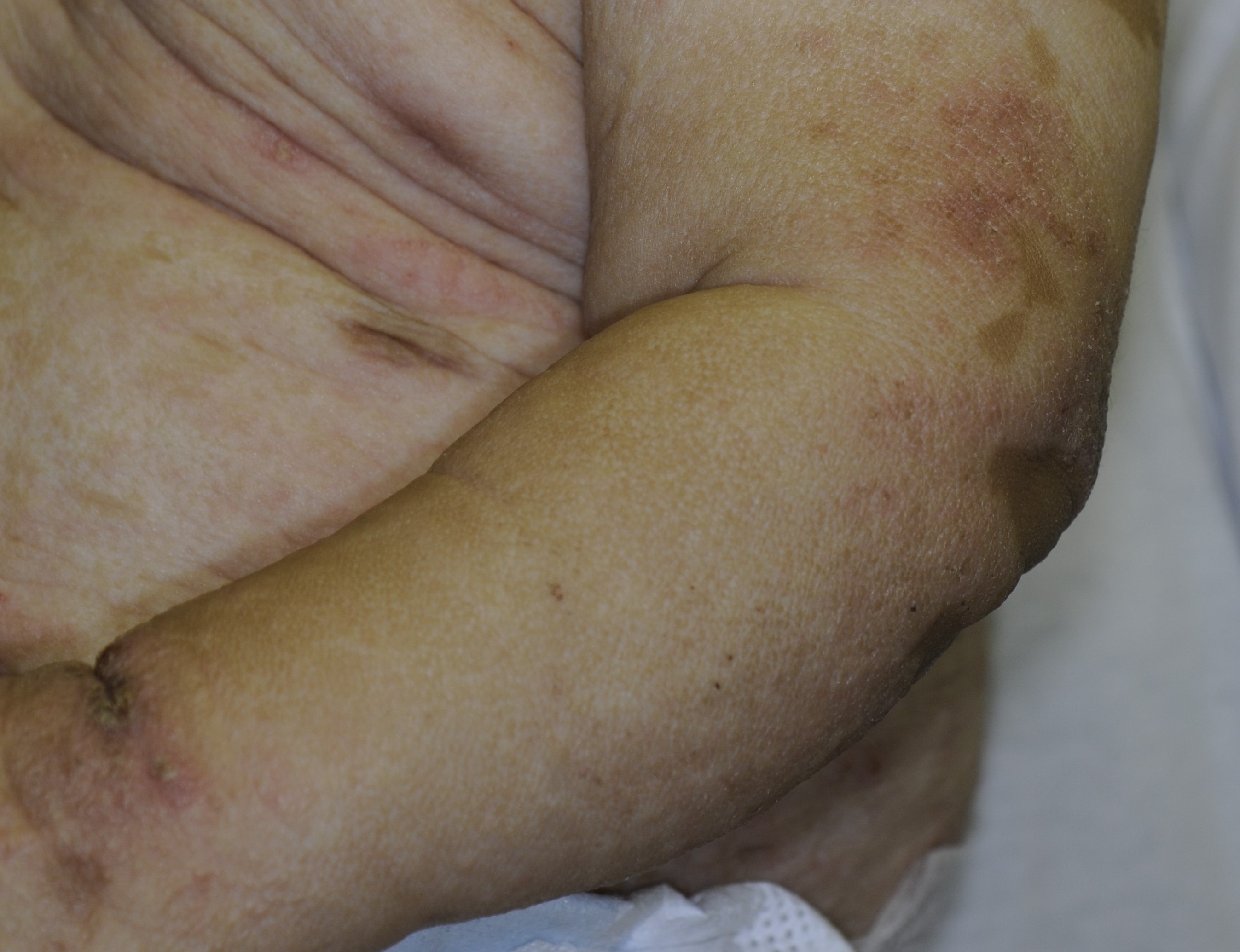 Neonatal Lupus 3b