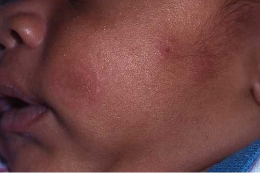 Neonatal Lupus 6a