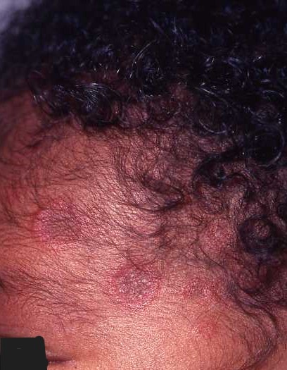 Neonatal Lupus
