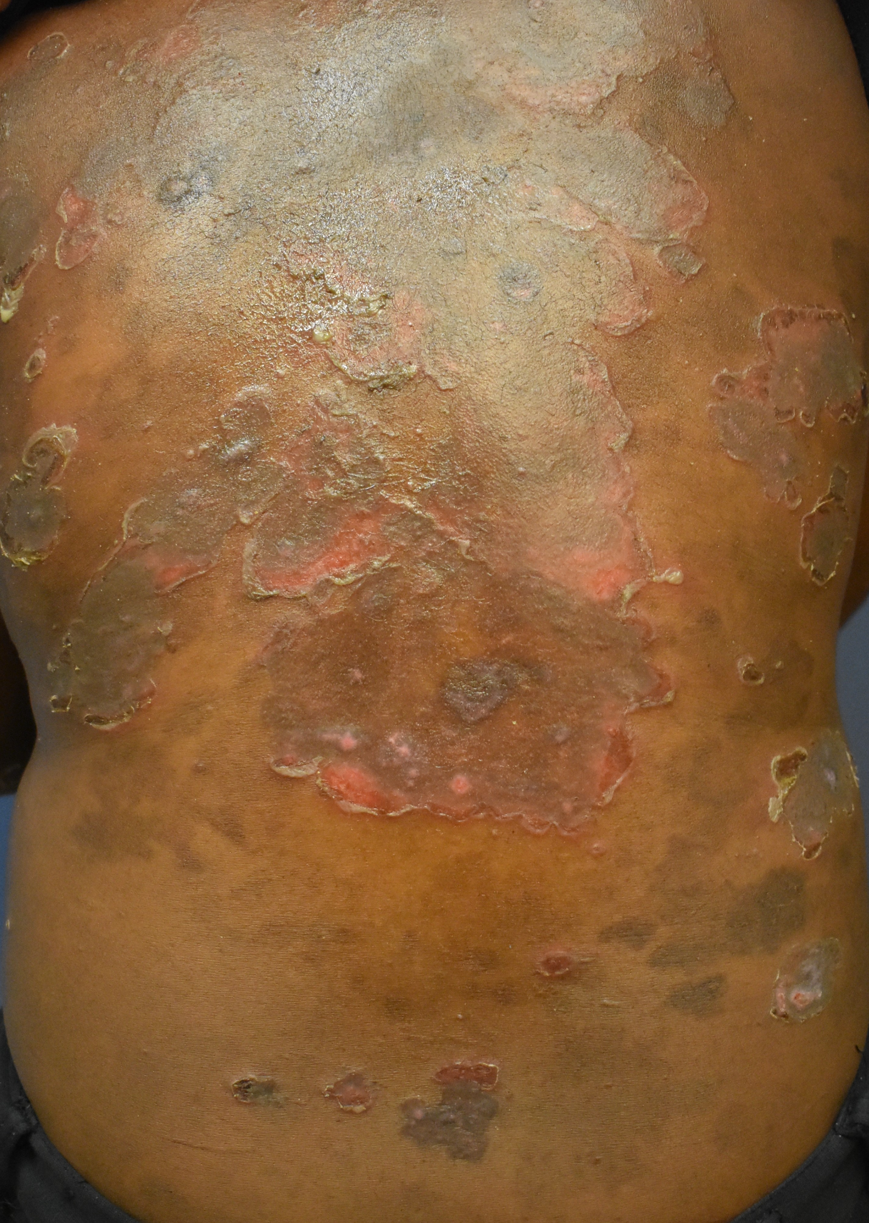 Pemphigus Foliaceus 5a