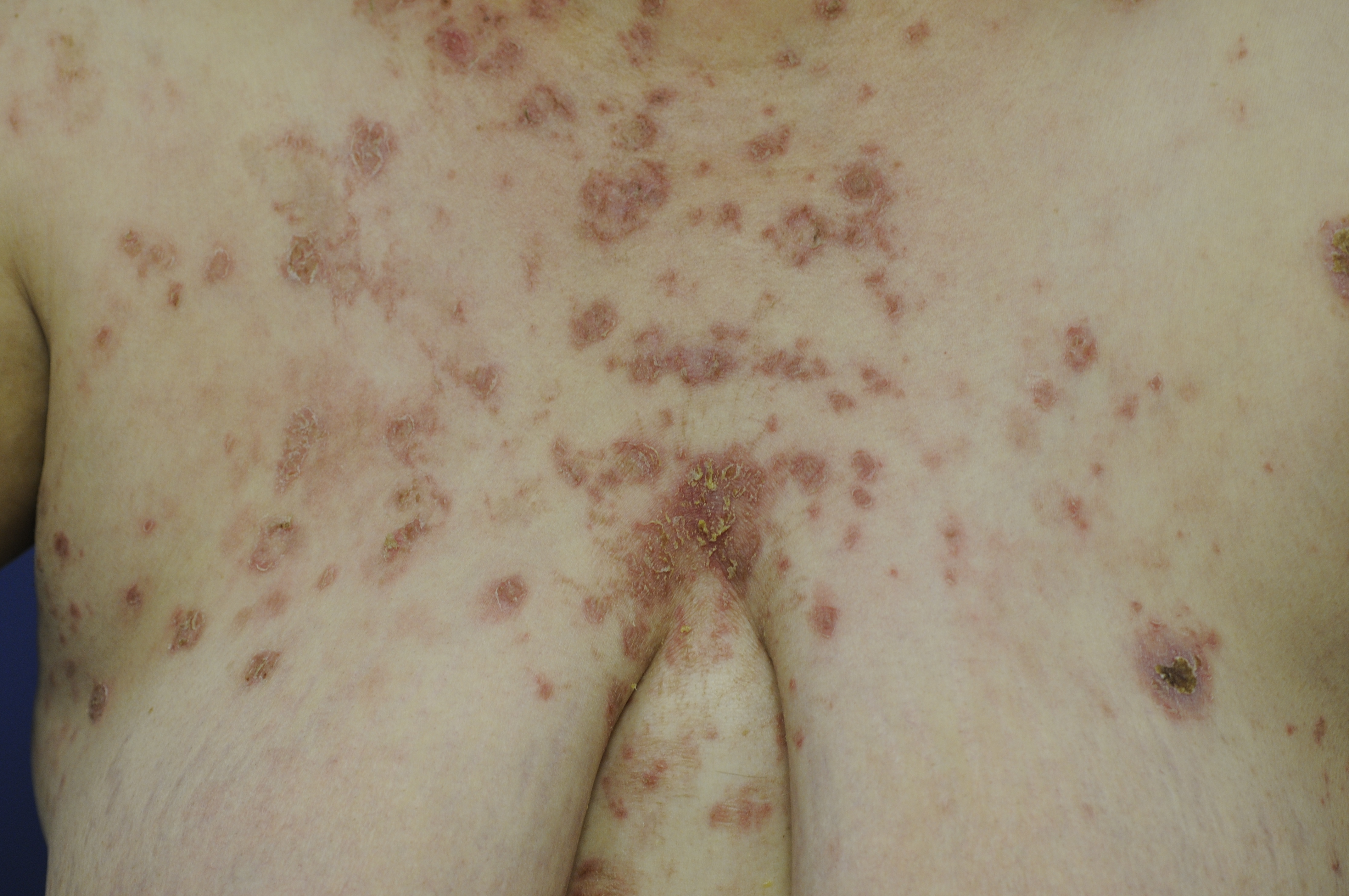 Pemphigus Foliaceus 1a