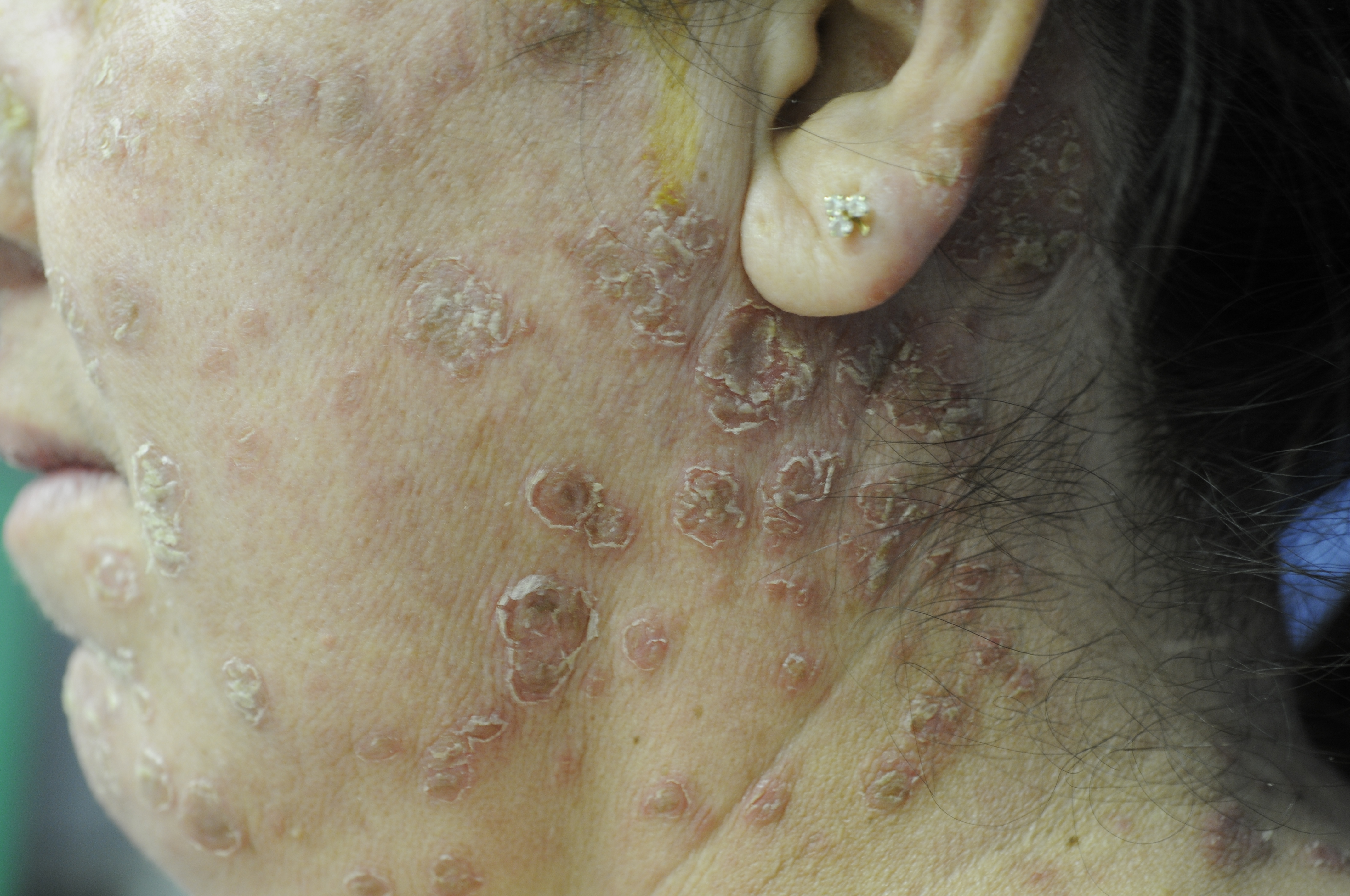 Pemphigus Foliaceus 1b