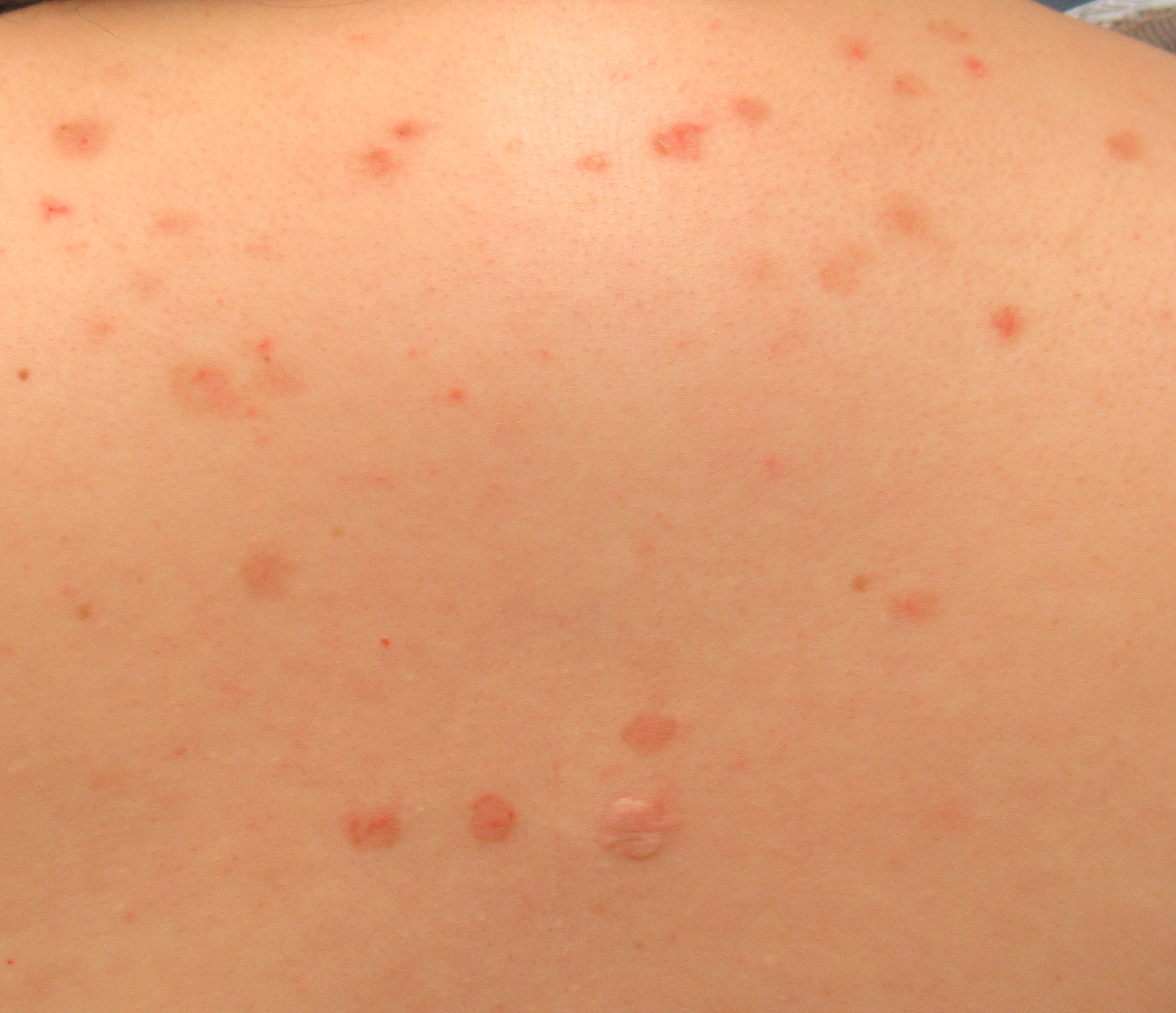 Pemphigus Foliaceus 2a