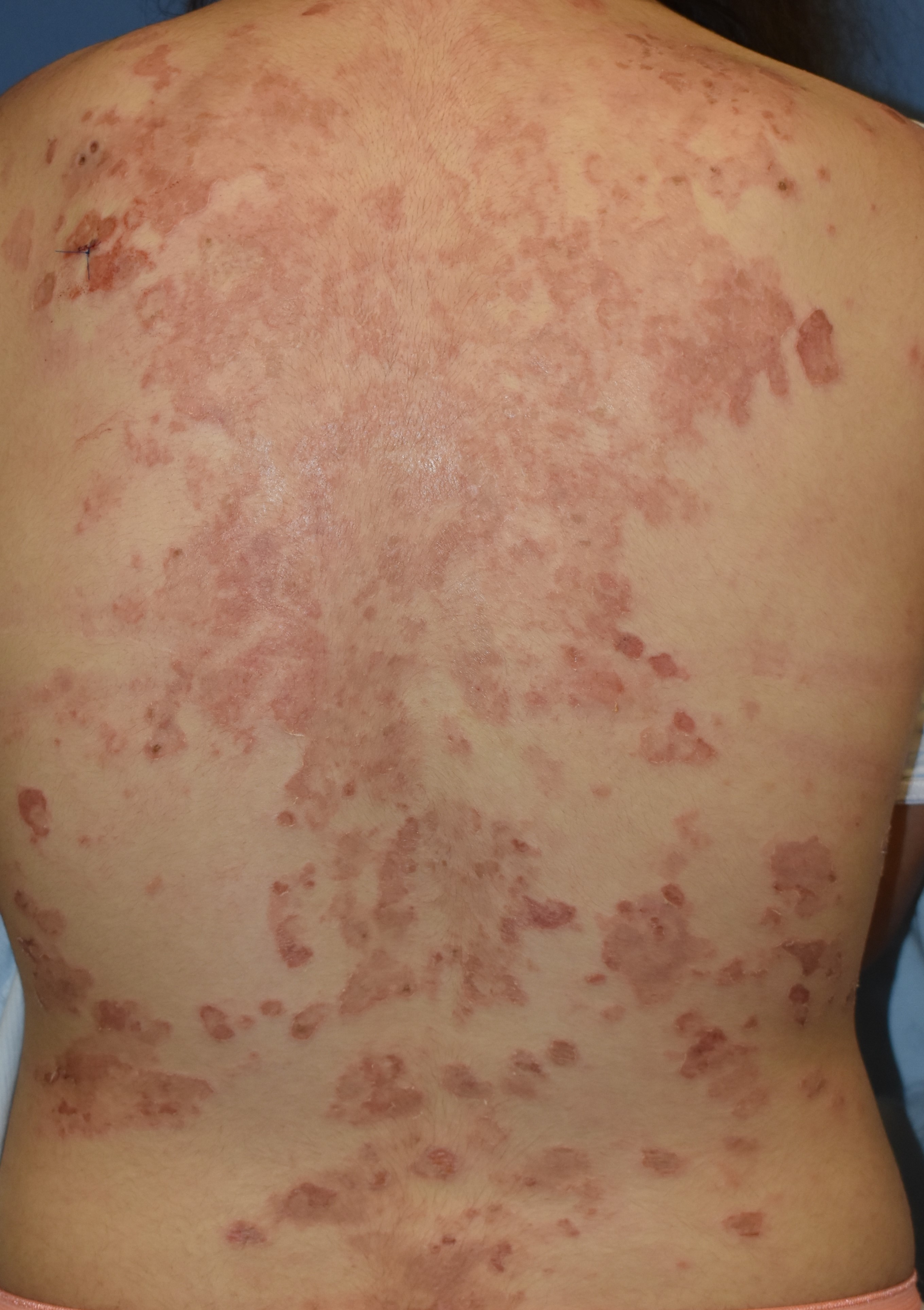 Pemphigus Foliaceus 2b