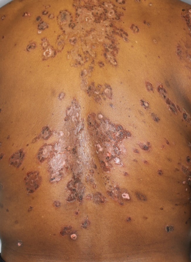 Pemphigus Foliaceus 4a