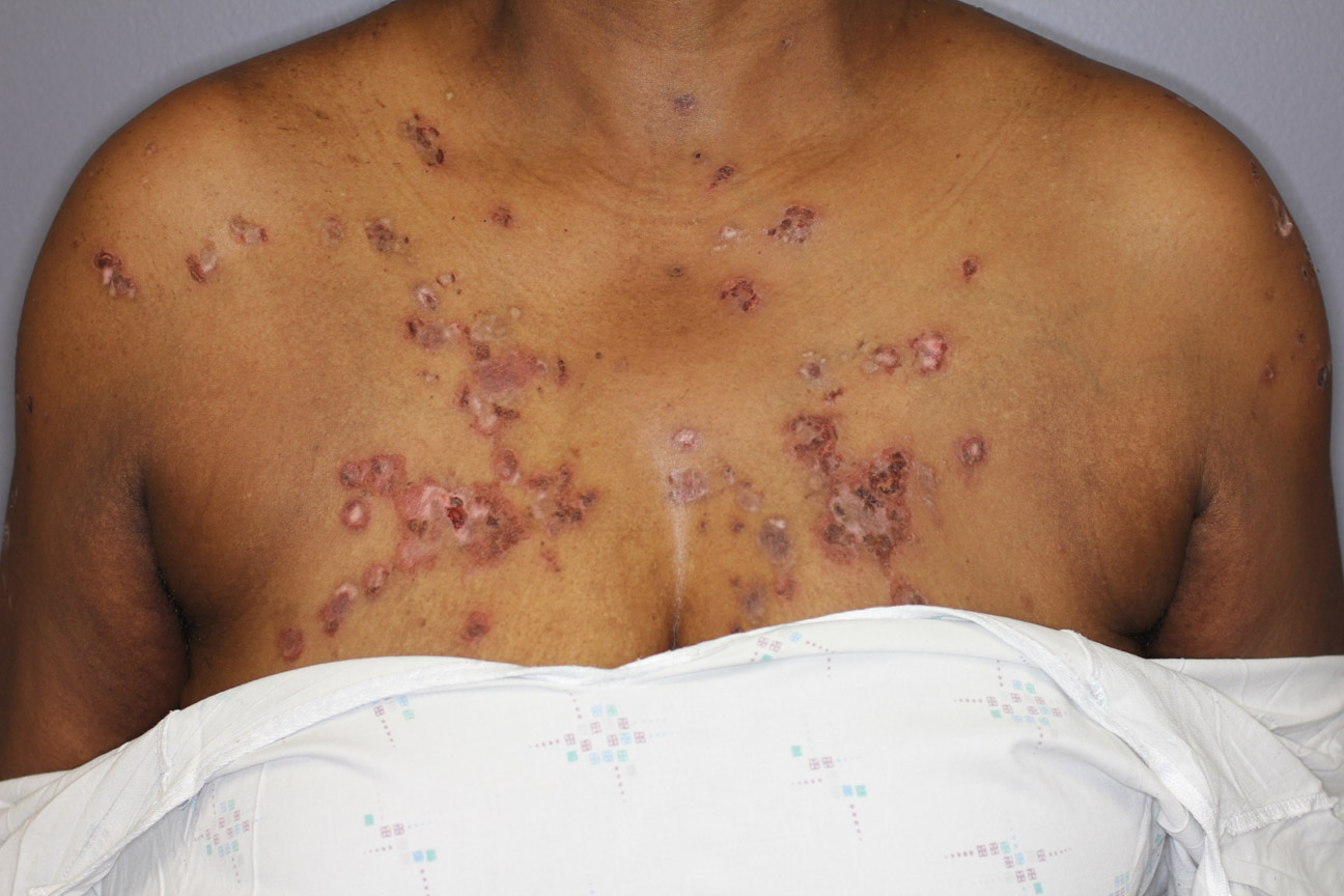 Pemphigus Foliaceus