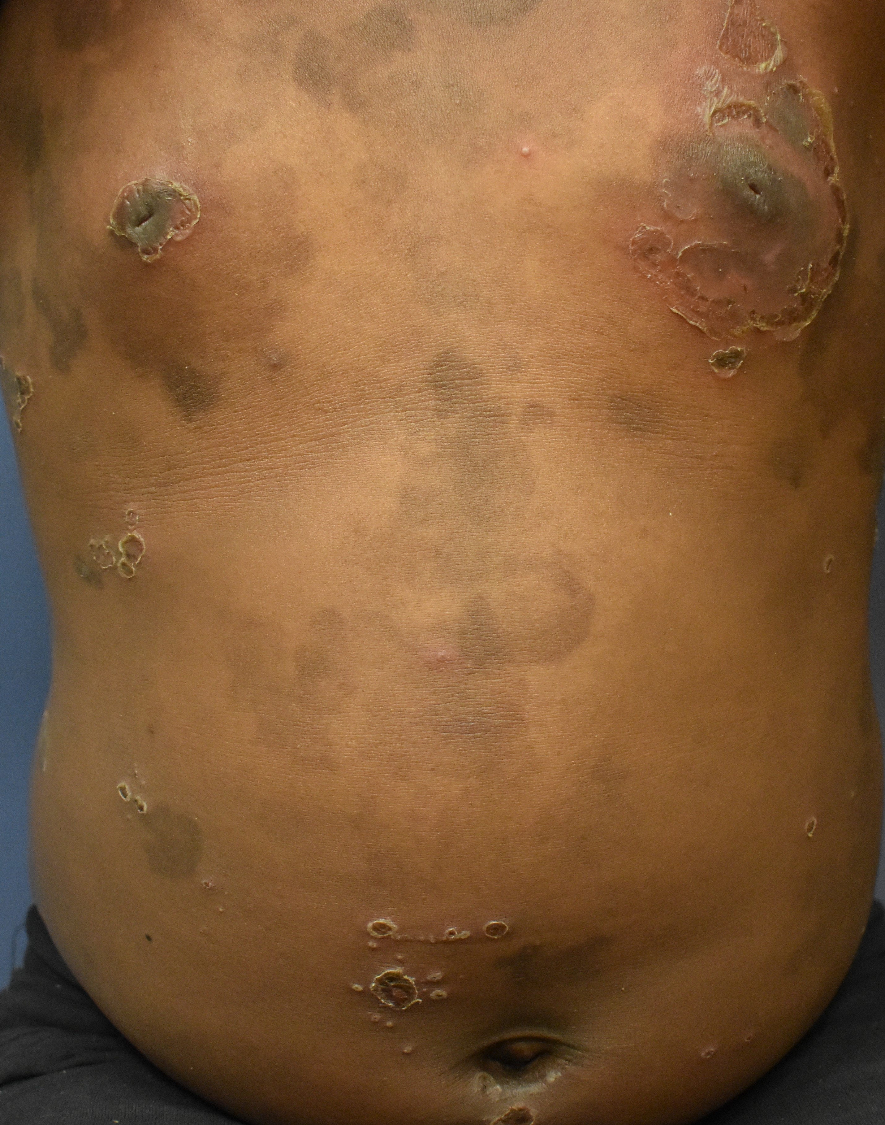 Pemphigus Foliaceus 5b