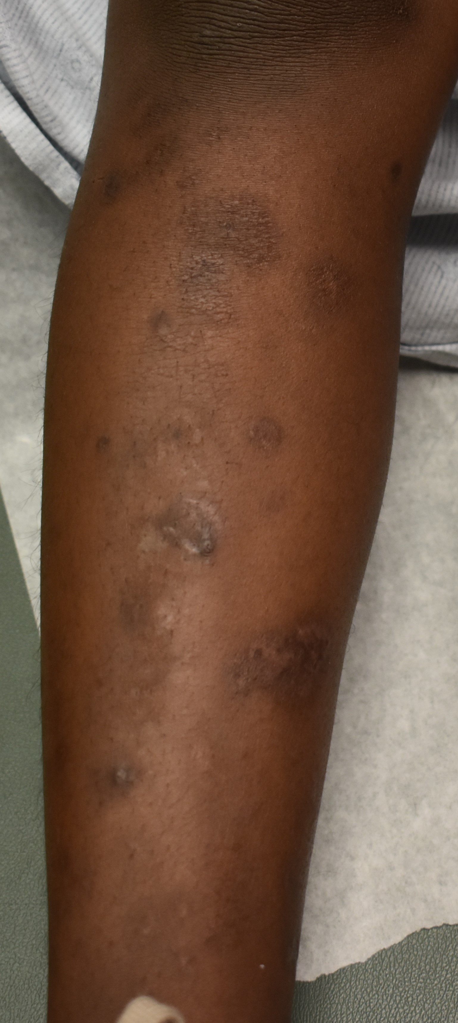 Pemphigus Foliaceus 6b