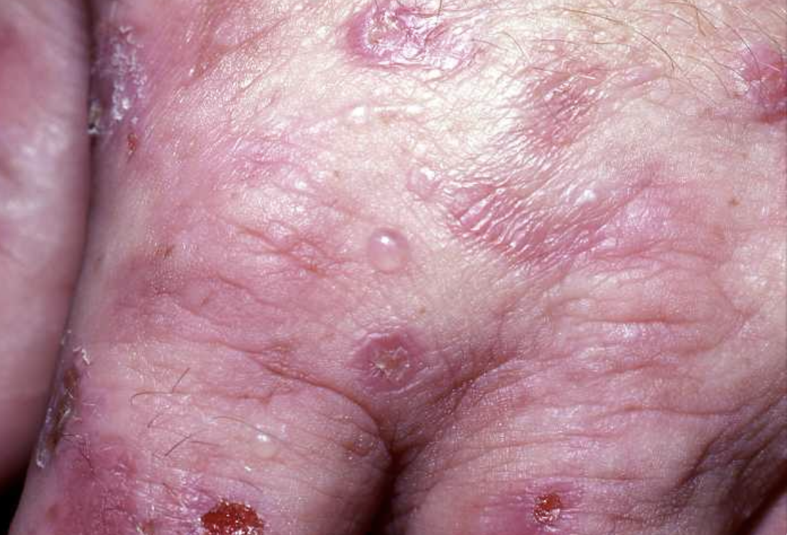 Porphyria Cutanea Tarda PCT 1b