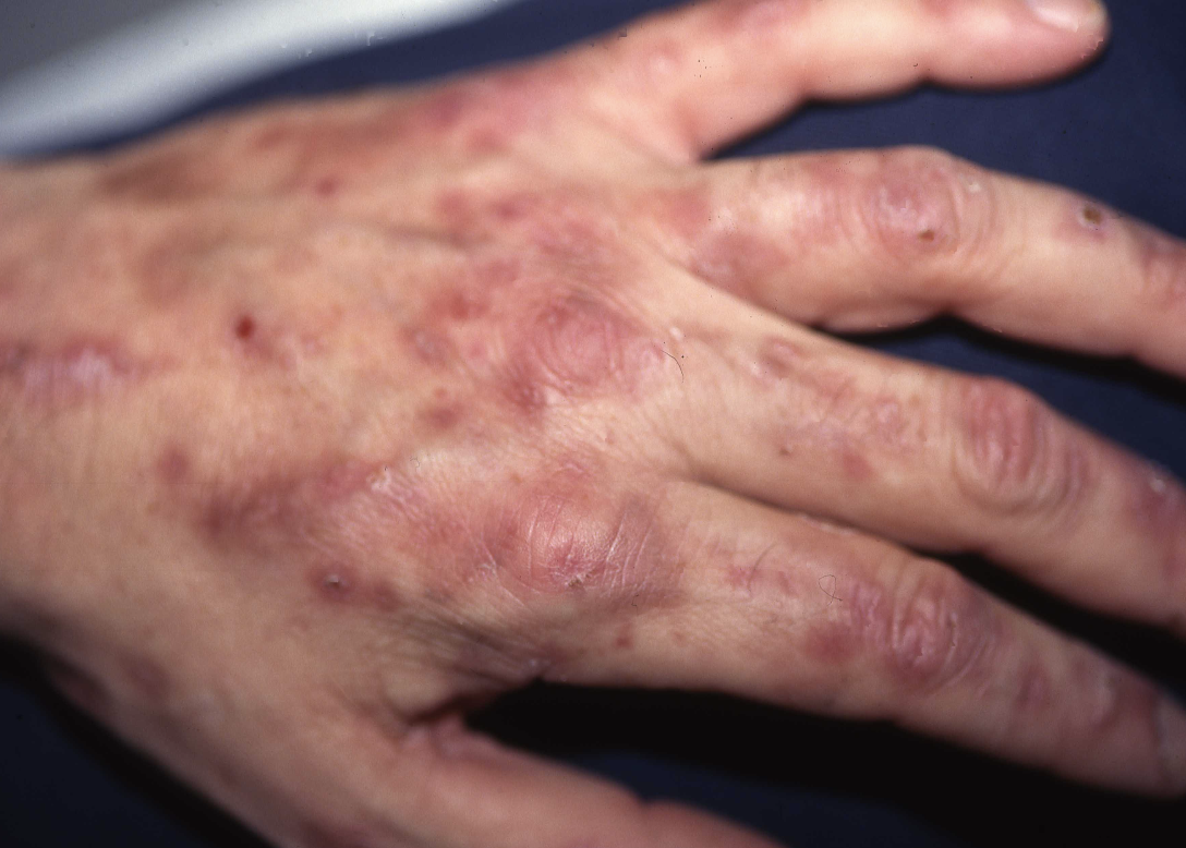 Porphyria Cutanea Tarda PCT 2a