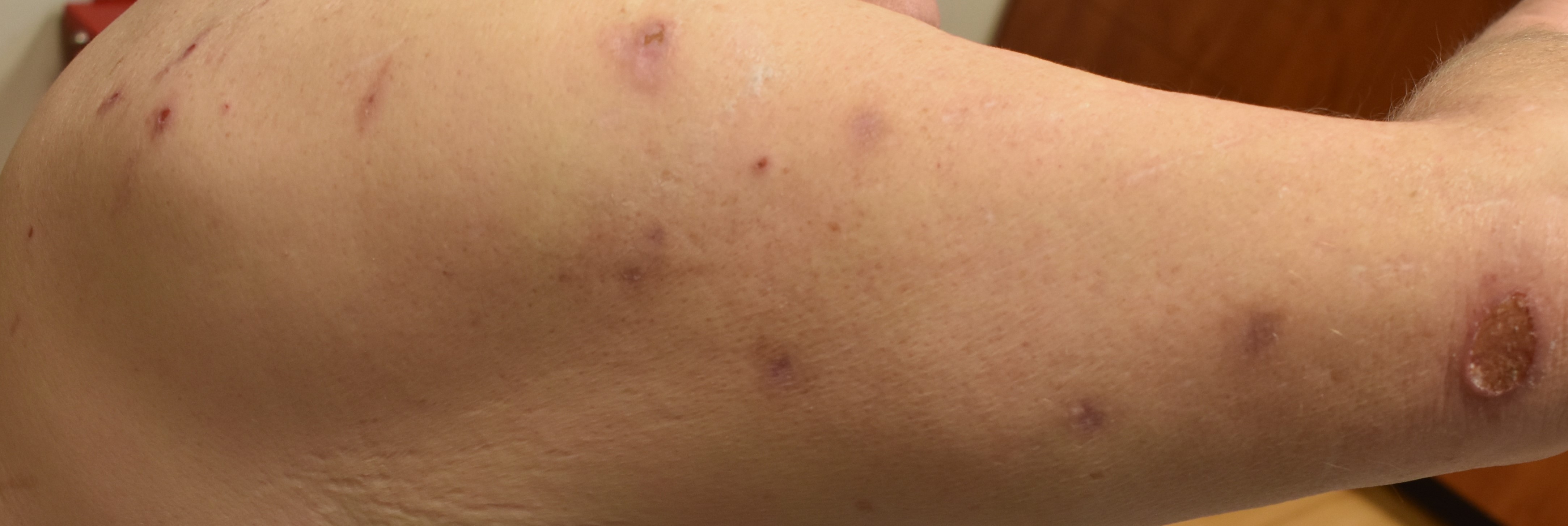 Sarcoidosis 2a