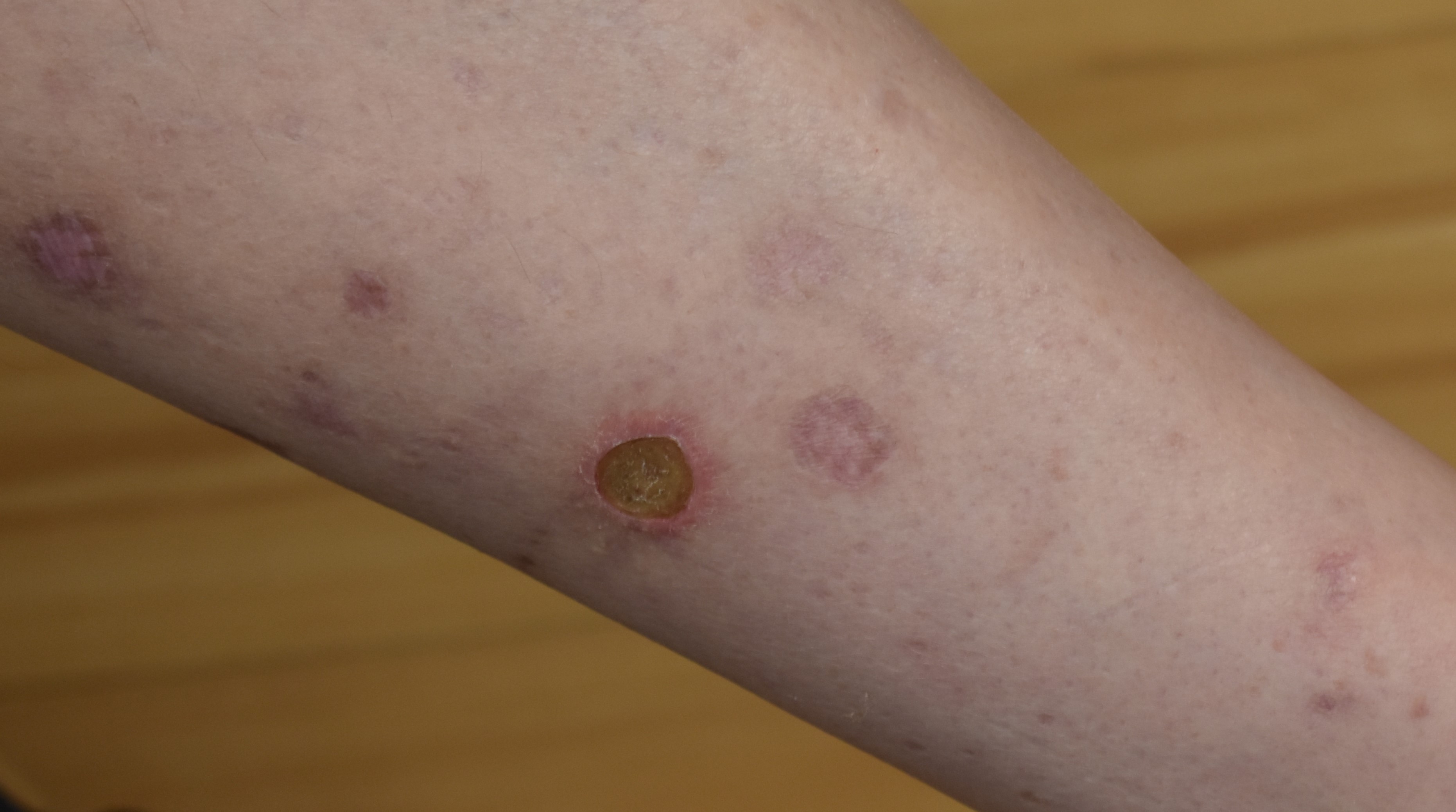 Sarcoidosis 2b