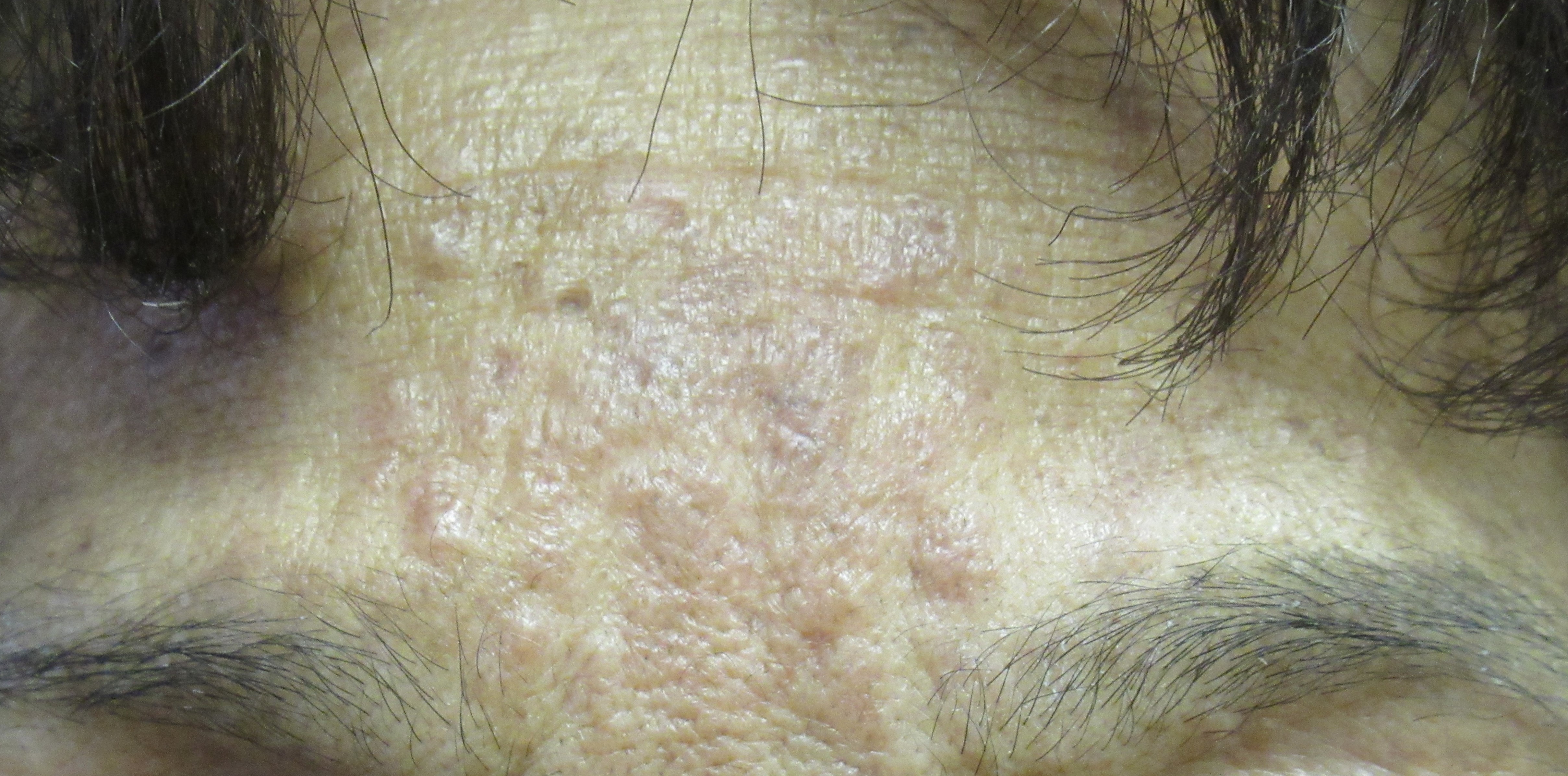 Sarcoidosis 3a