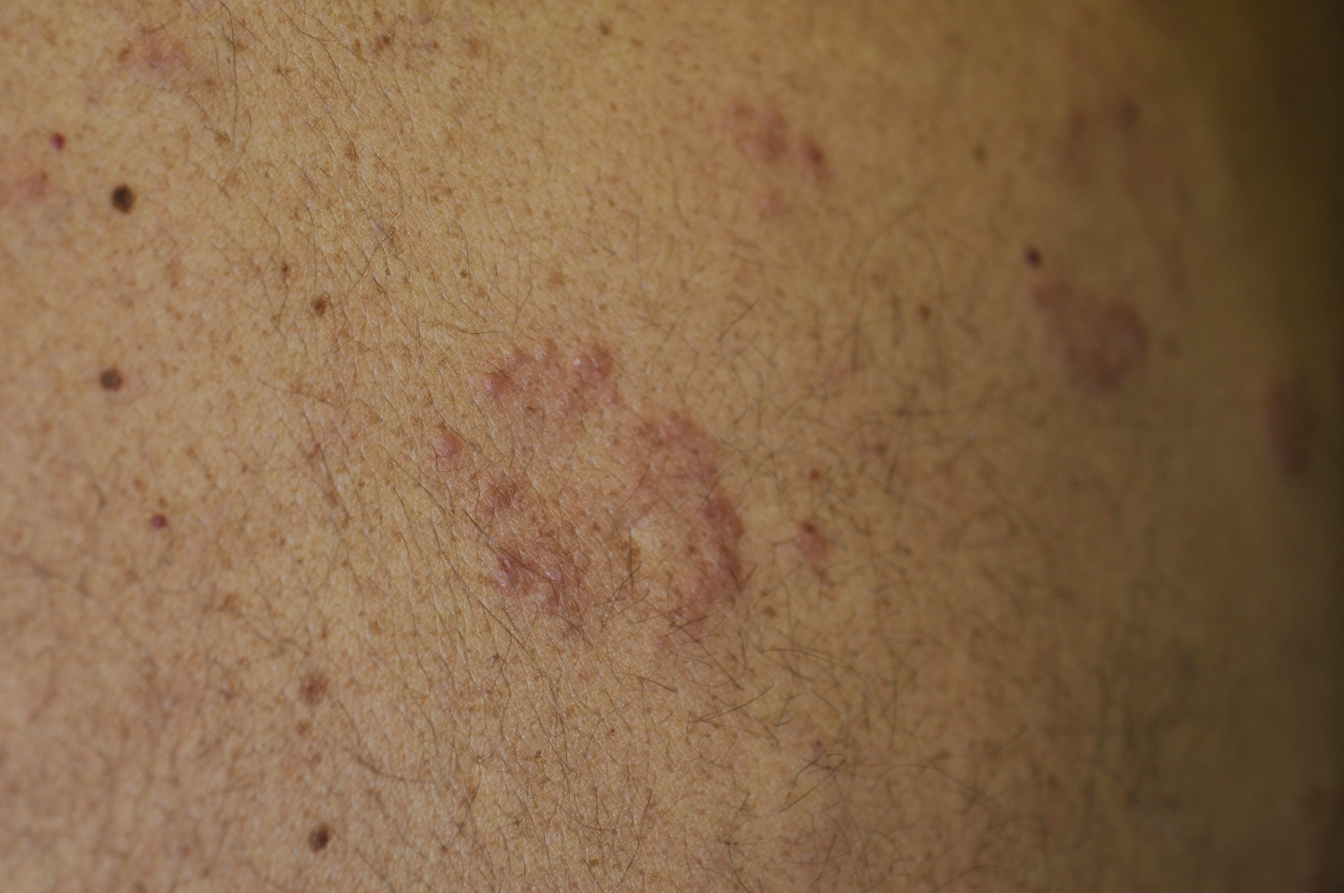 Sarcoidosis 3b