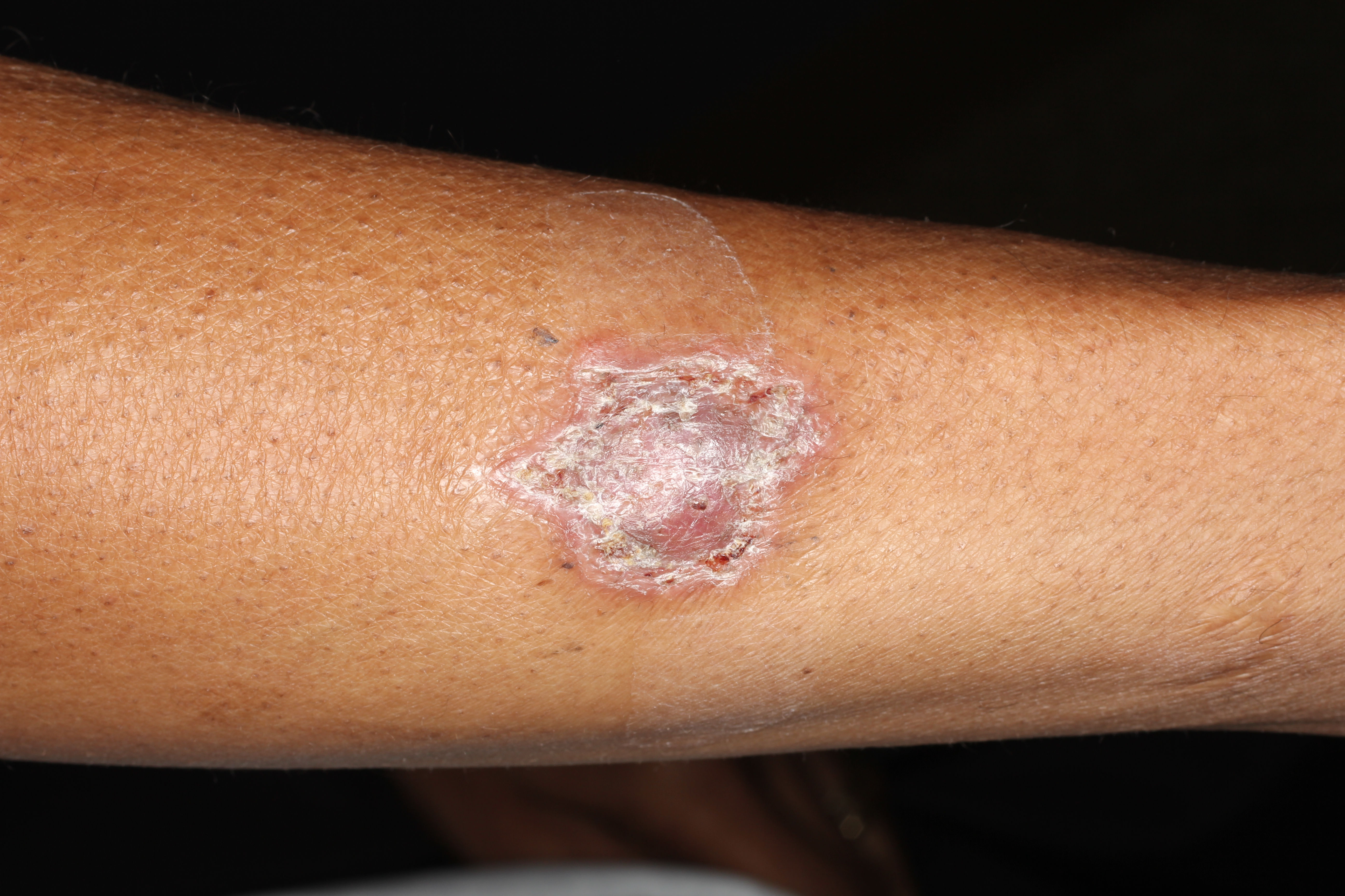 Sarcoidosis 4a