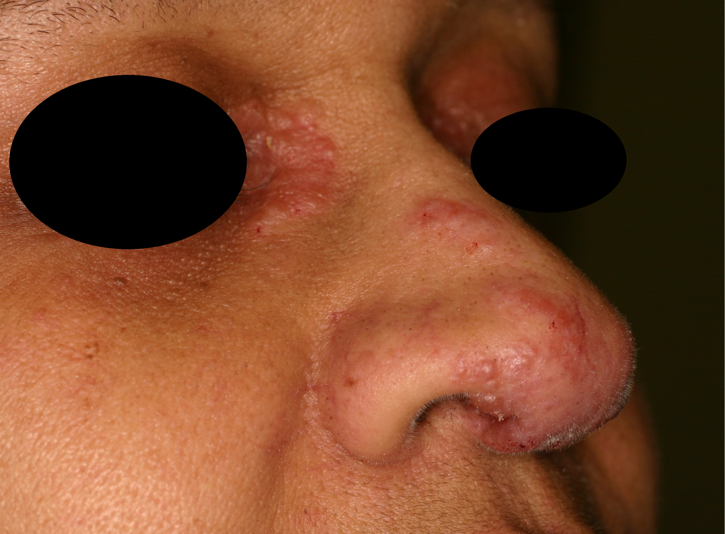 Sarcoidosis 4b