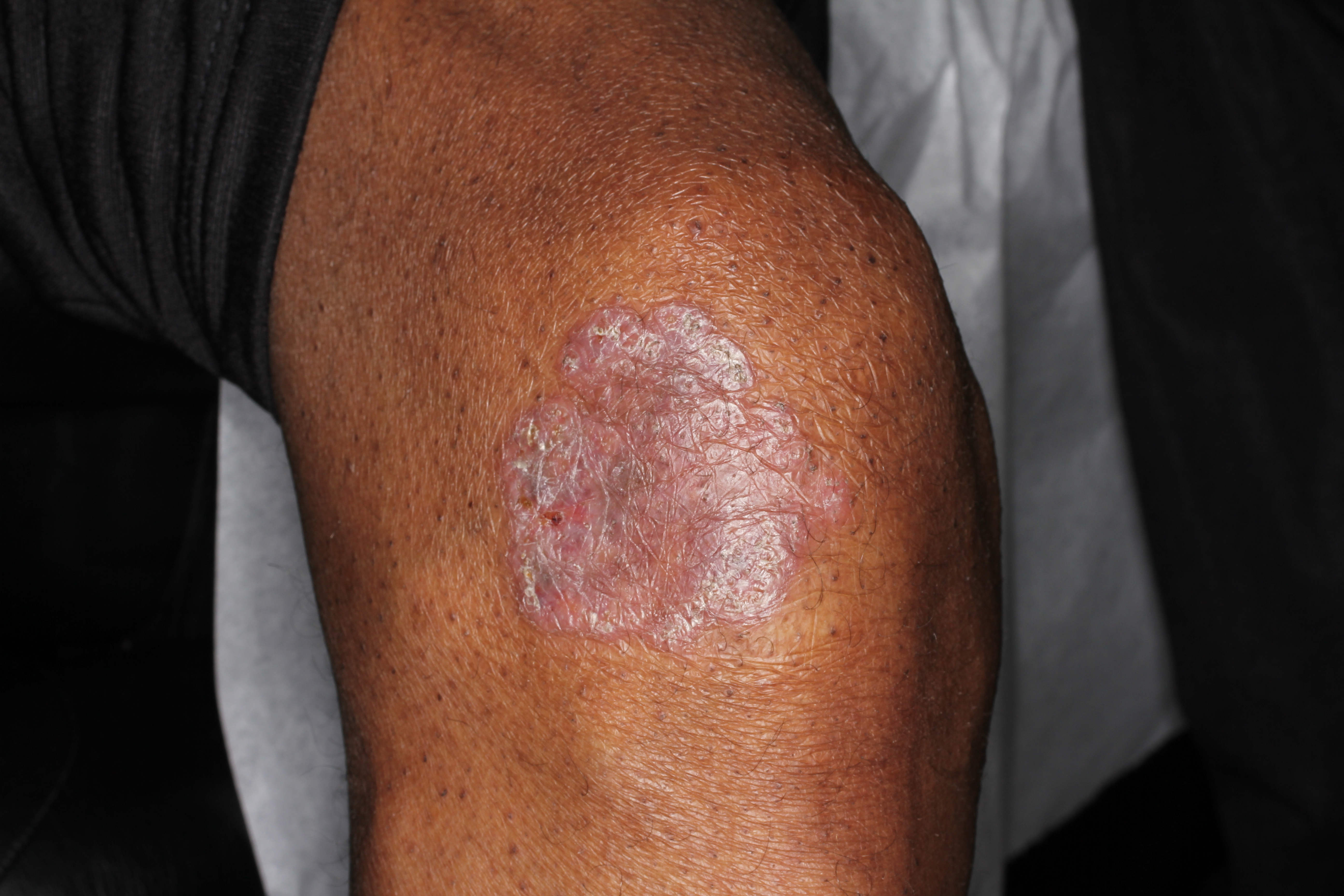 Sarcoidosis 5a