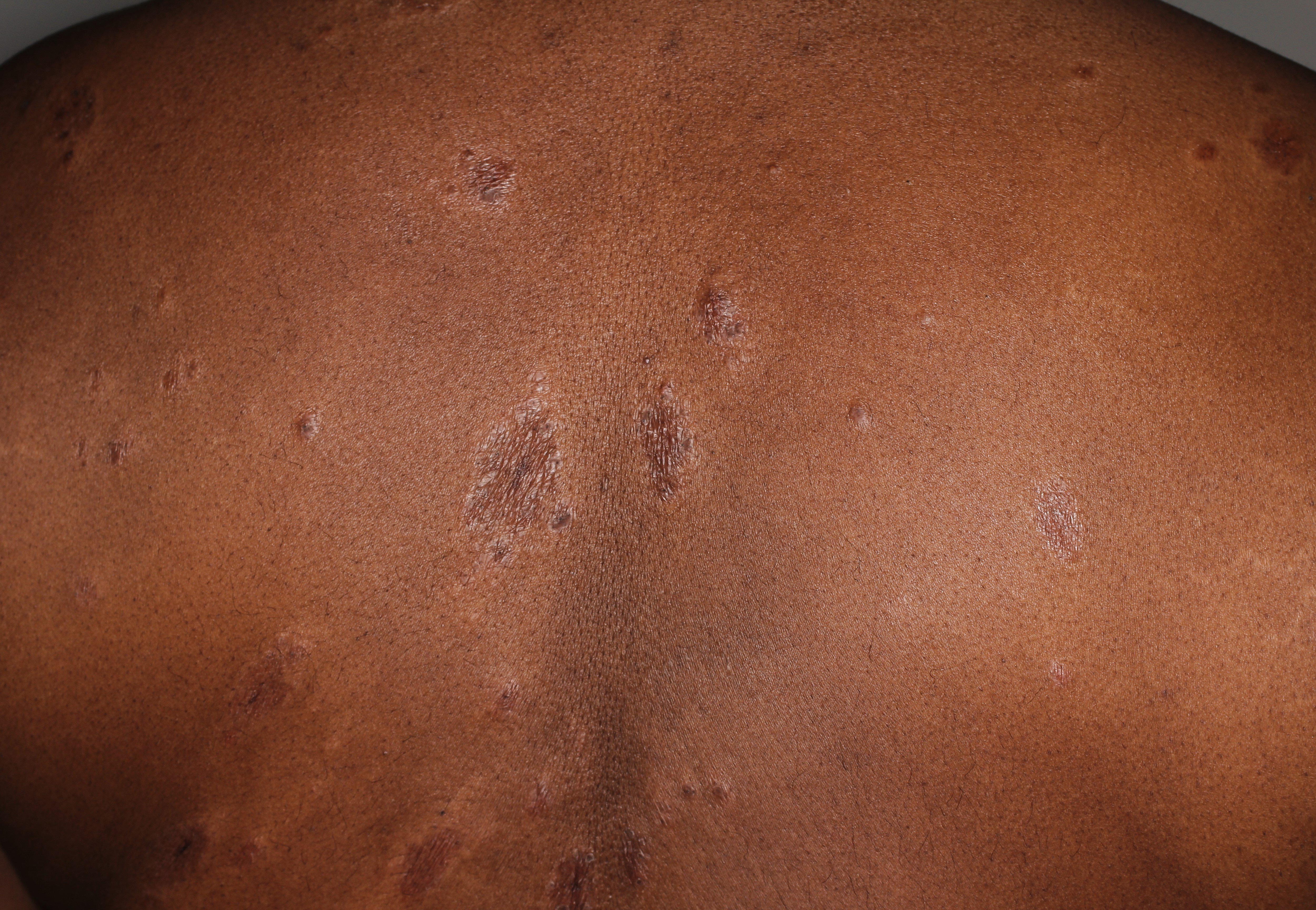 Sarcoidosis 6a
