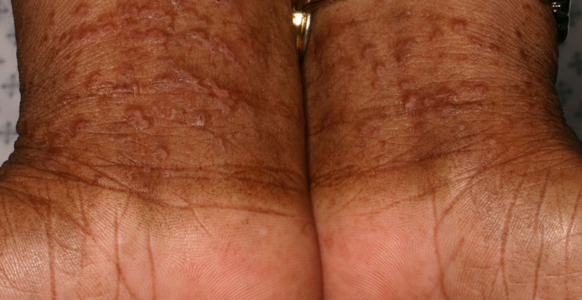 Sarcoidosis 6b