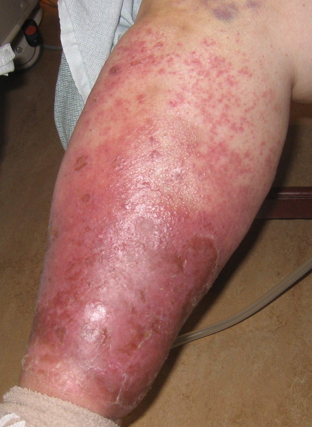 Stasis Dermatitis 1a