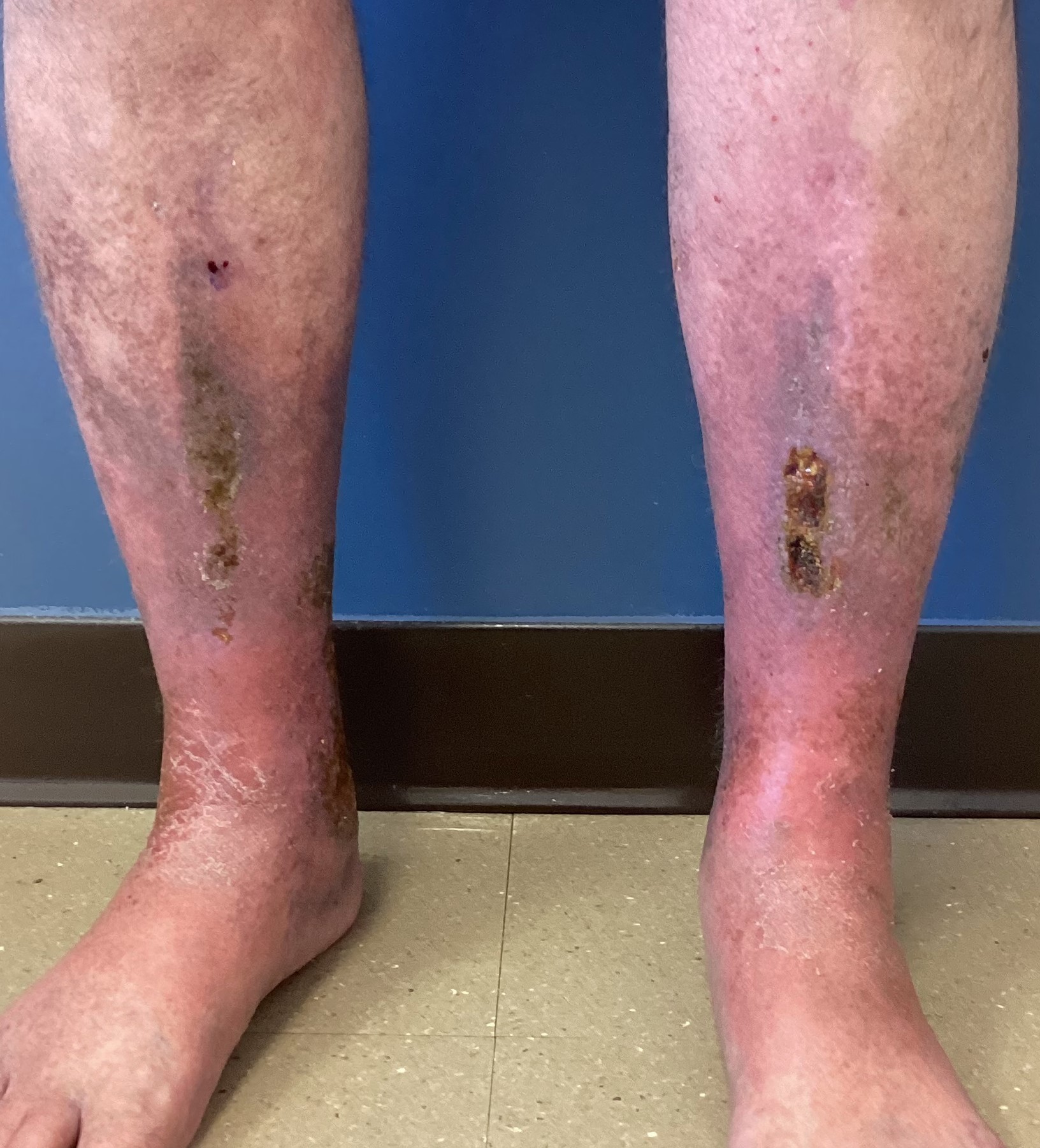 Stasis Dermatitis 1b