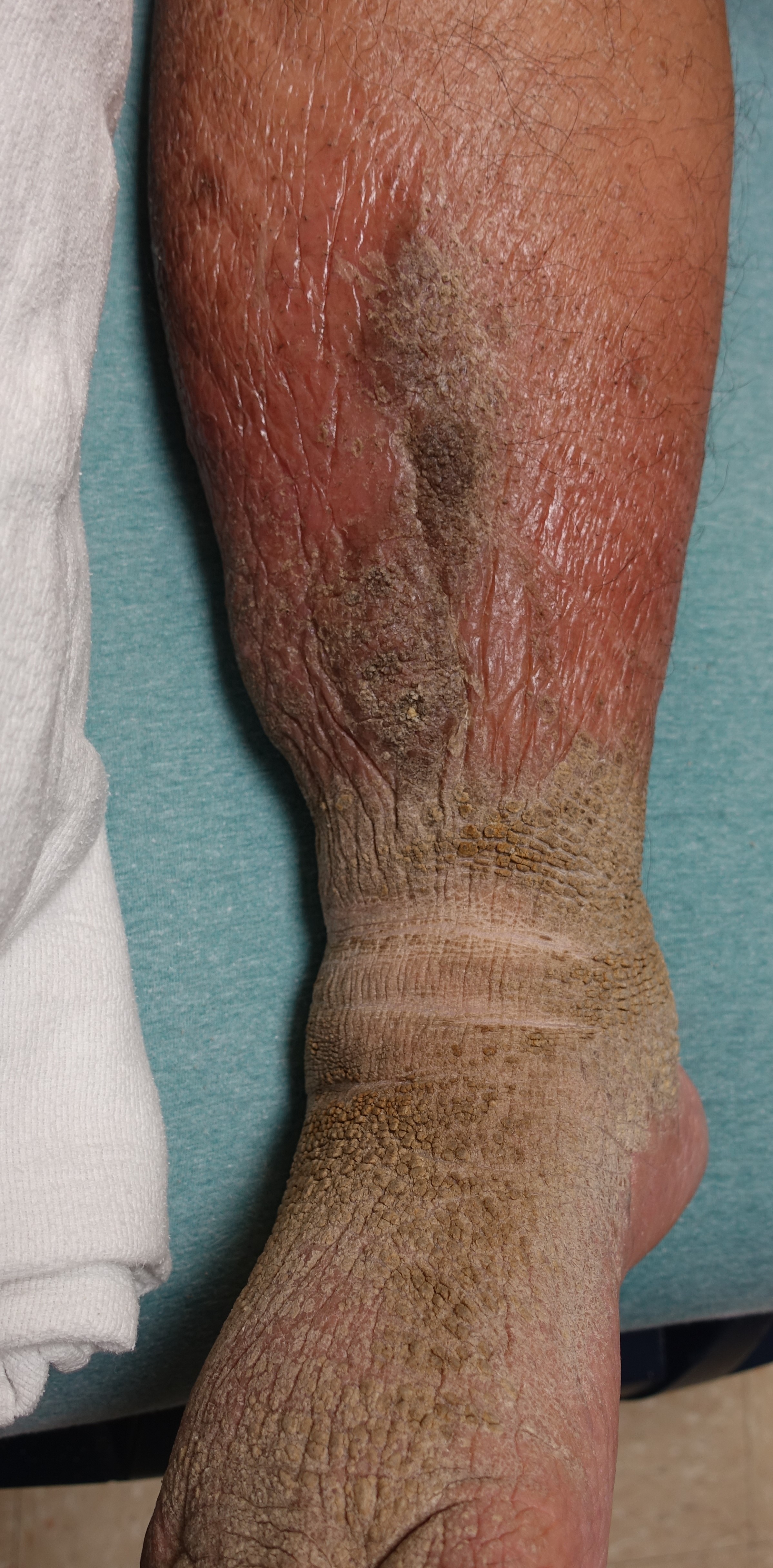 Stasis Dermatitis 2a
