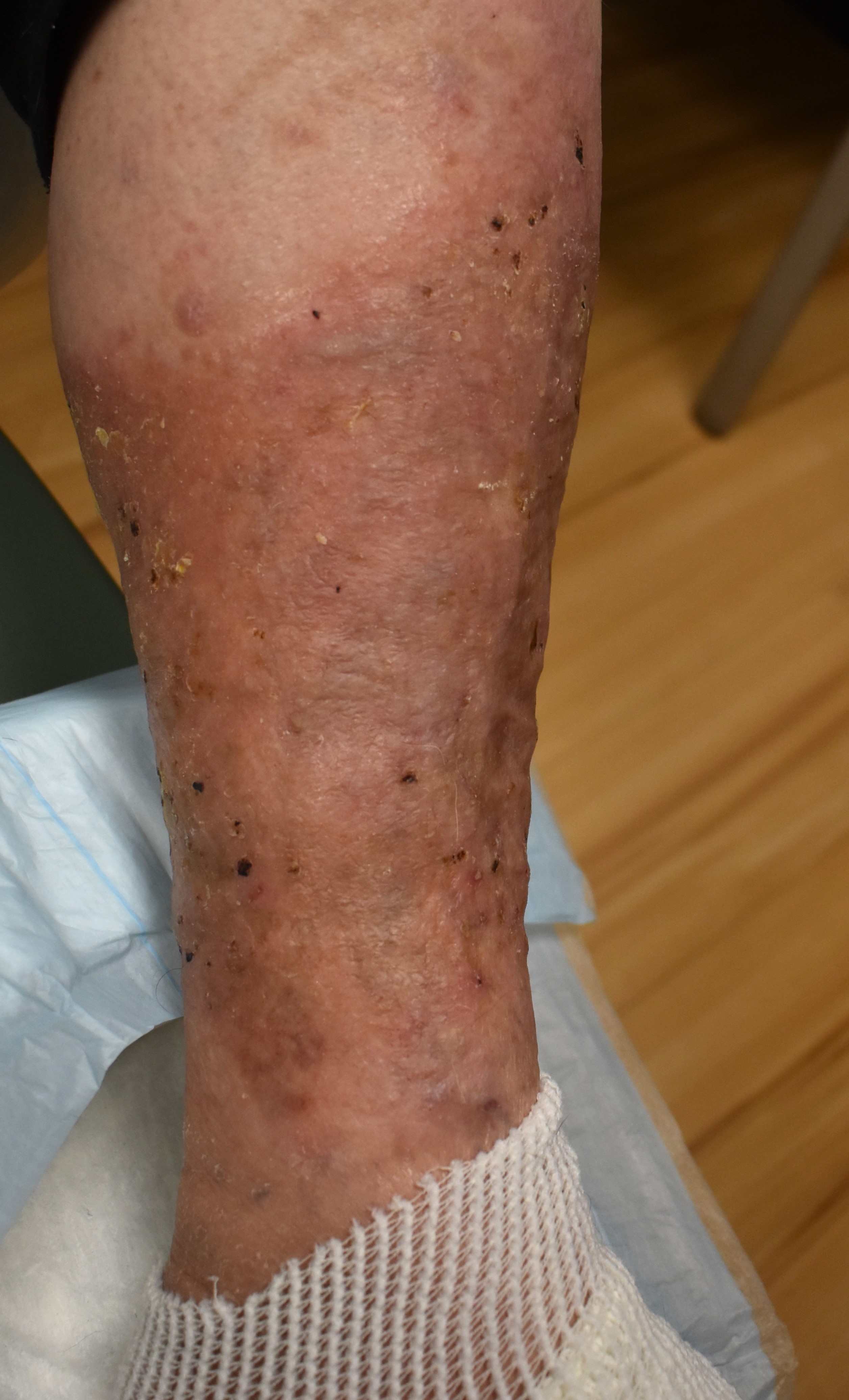 Stasis Dermatitis 2b