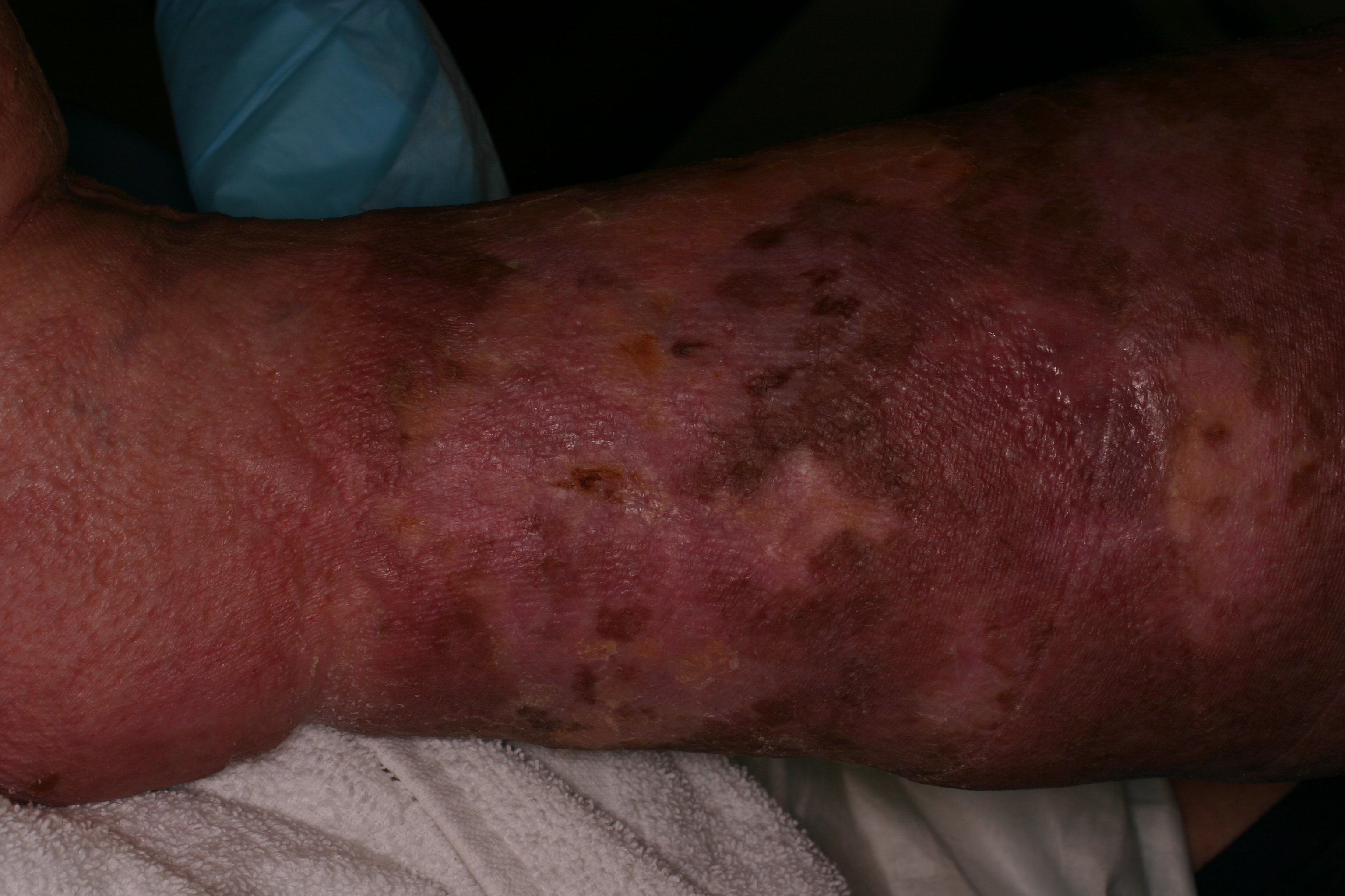 Stasis Dermatitis 4a