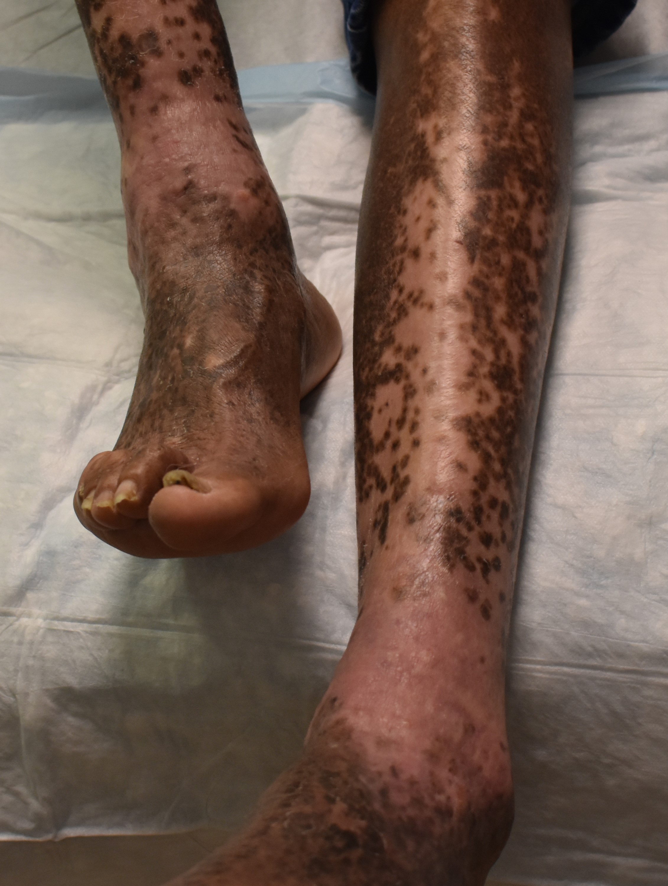 Stasis Dermatitis 6a