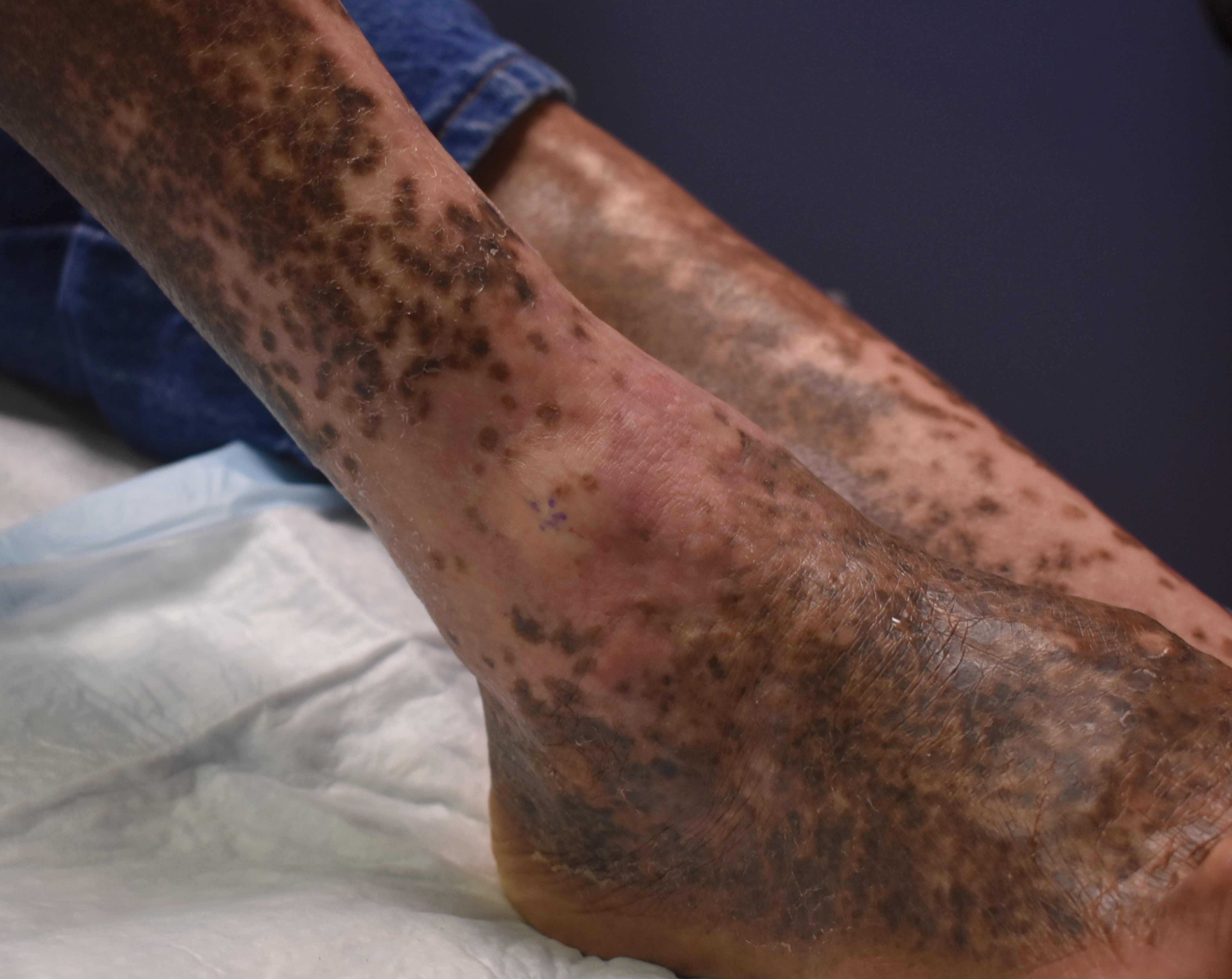 Stasis Dermatitis