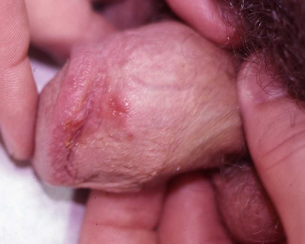 Syphilis 1a