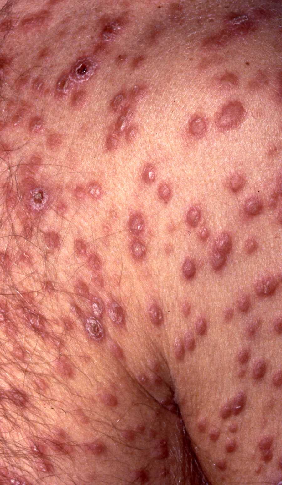 Syphilis 2a