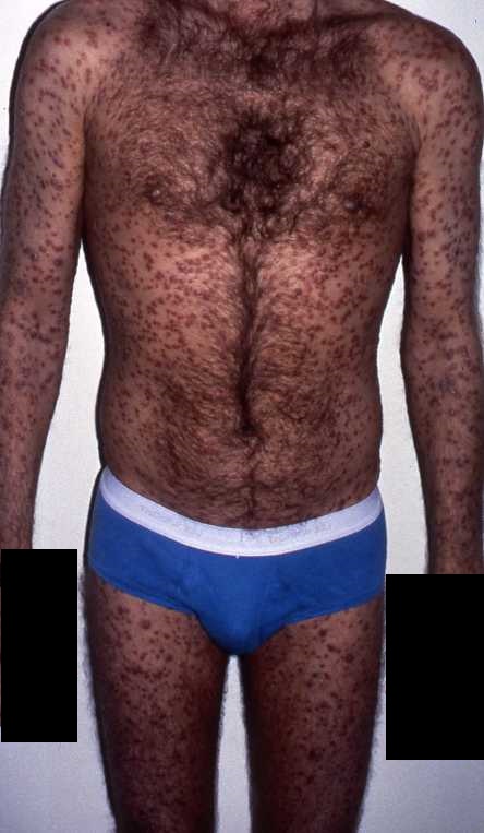 Syphilis 3a
