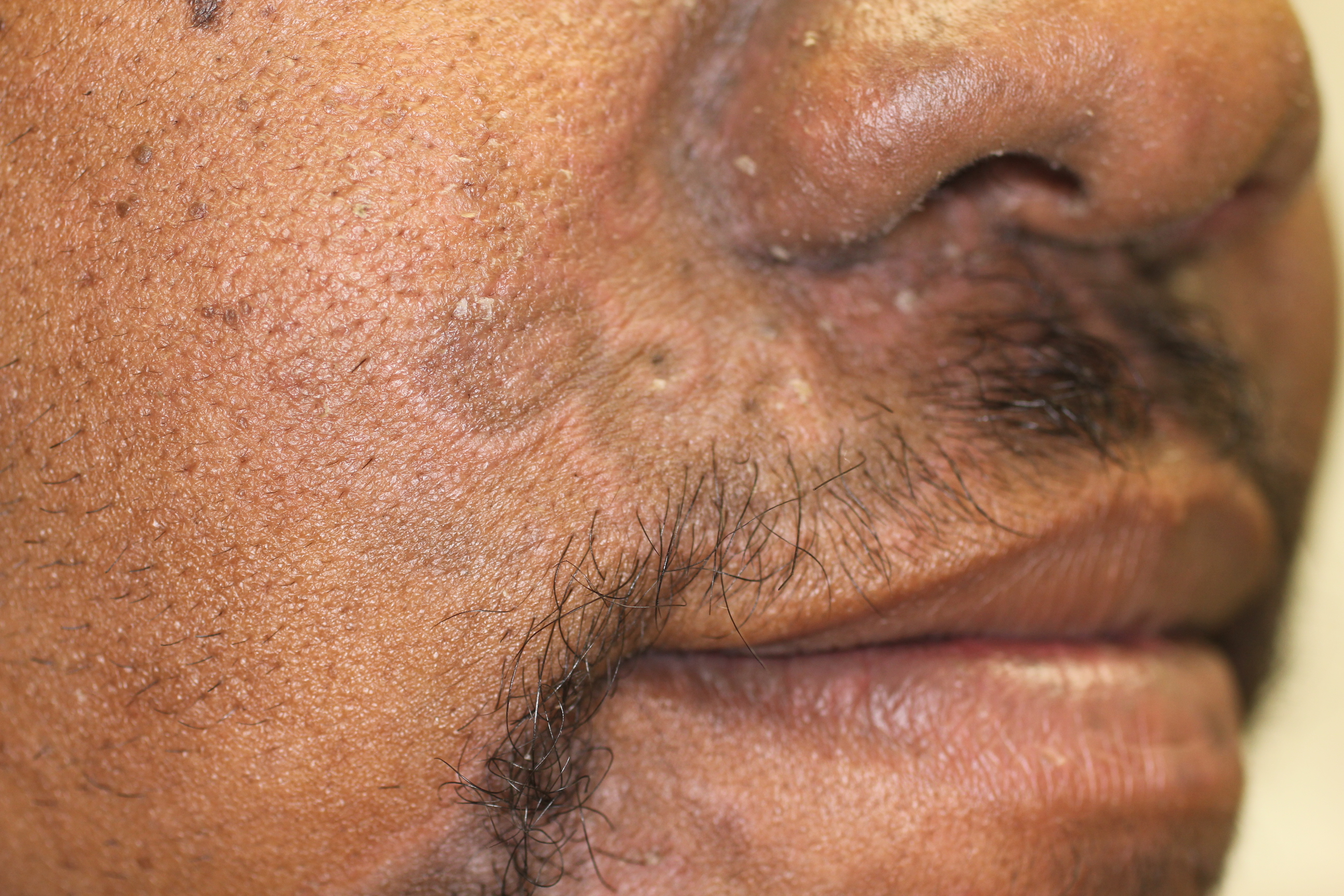 Syphilis 4a