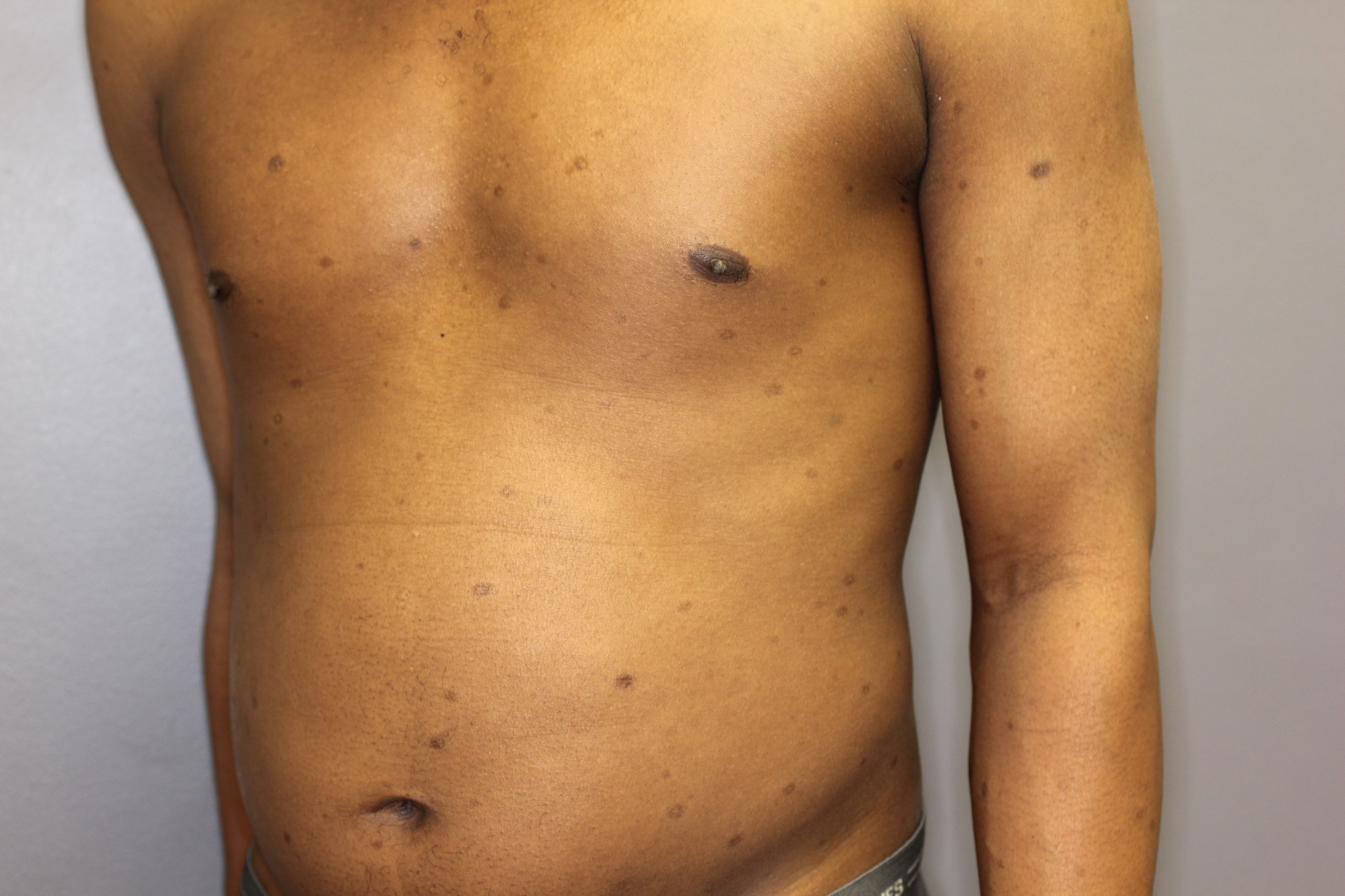 Syphilis 4b