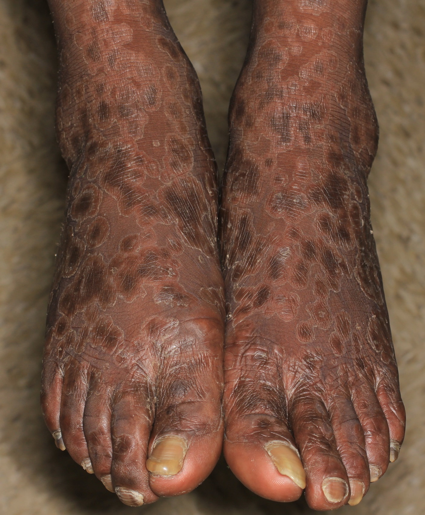 Syphilis 5a