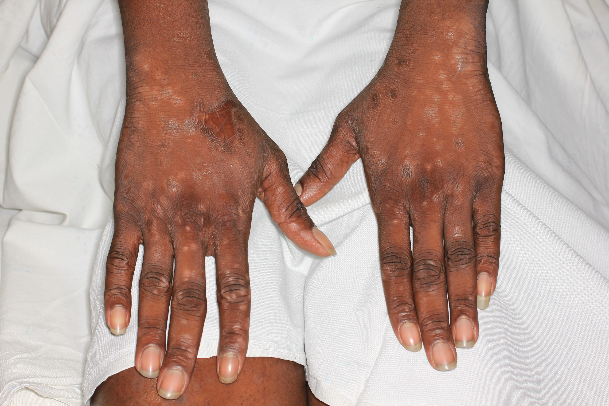 Syphilis 5b