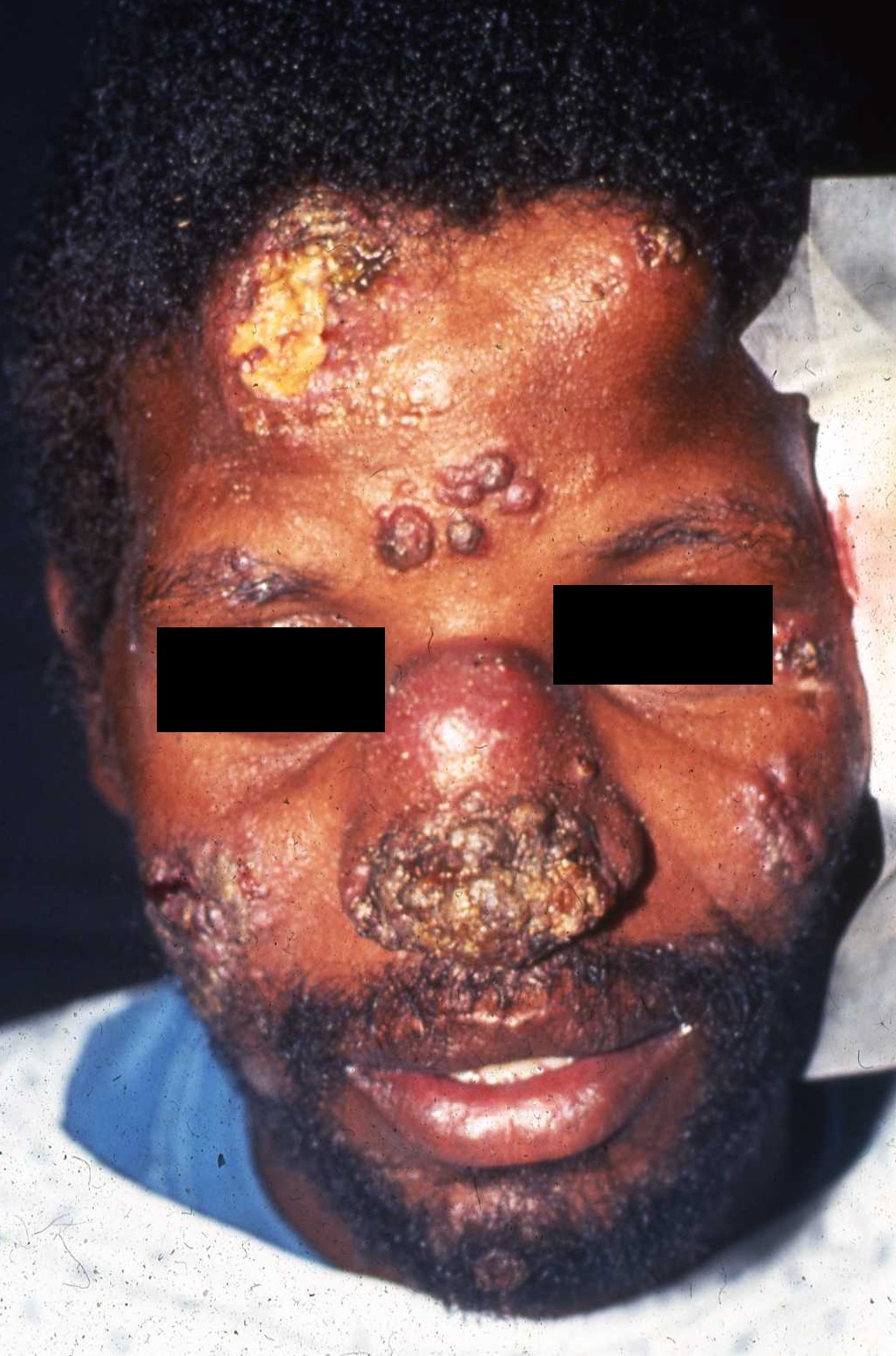 Syphilis