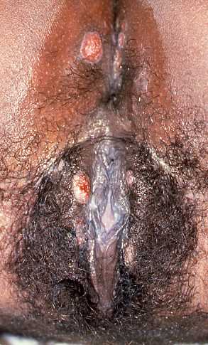 Syphilis 6a