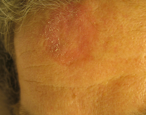 https://hsc.unm.edu/medicine/departments/dermatology/_images/skin-atlas/tinea-corporis/tinea-corporis-type-ii-2.jpg