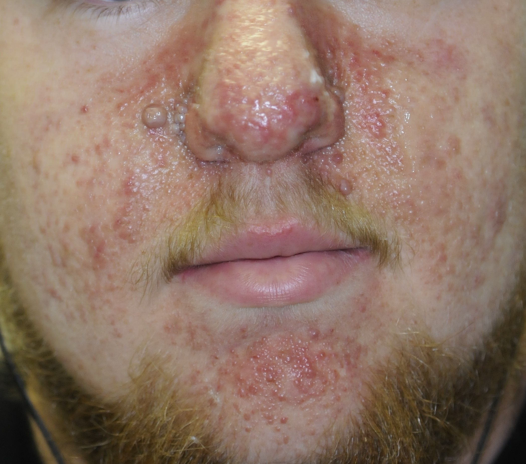 Tuberous Sclerosis 1a