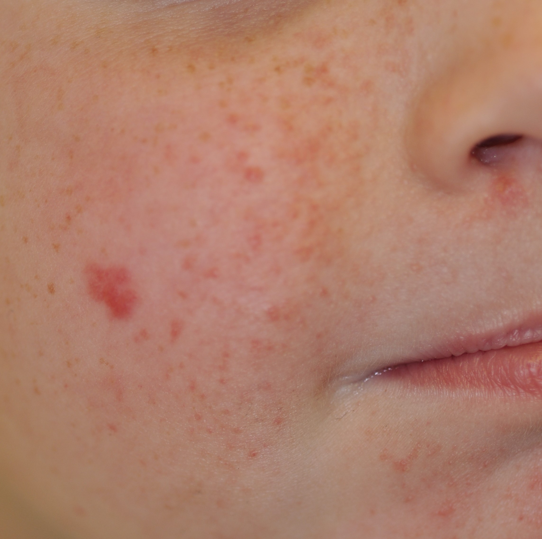 Tuberous Sclerosis 1b