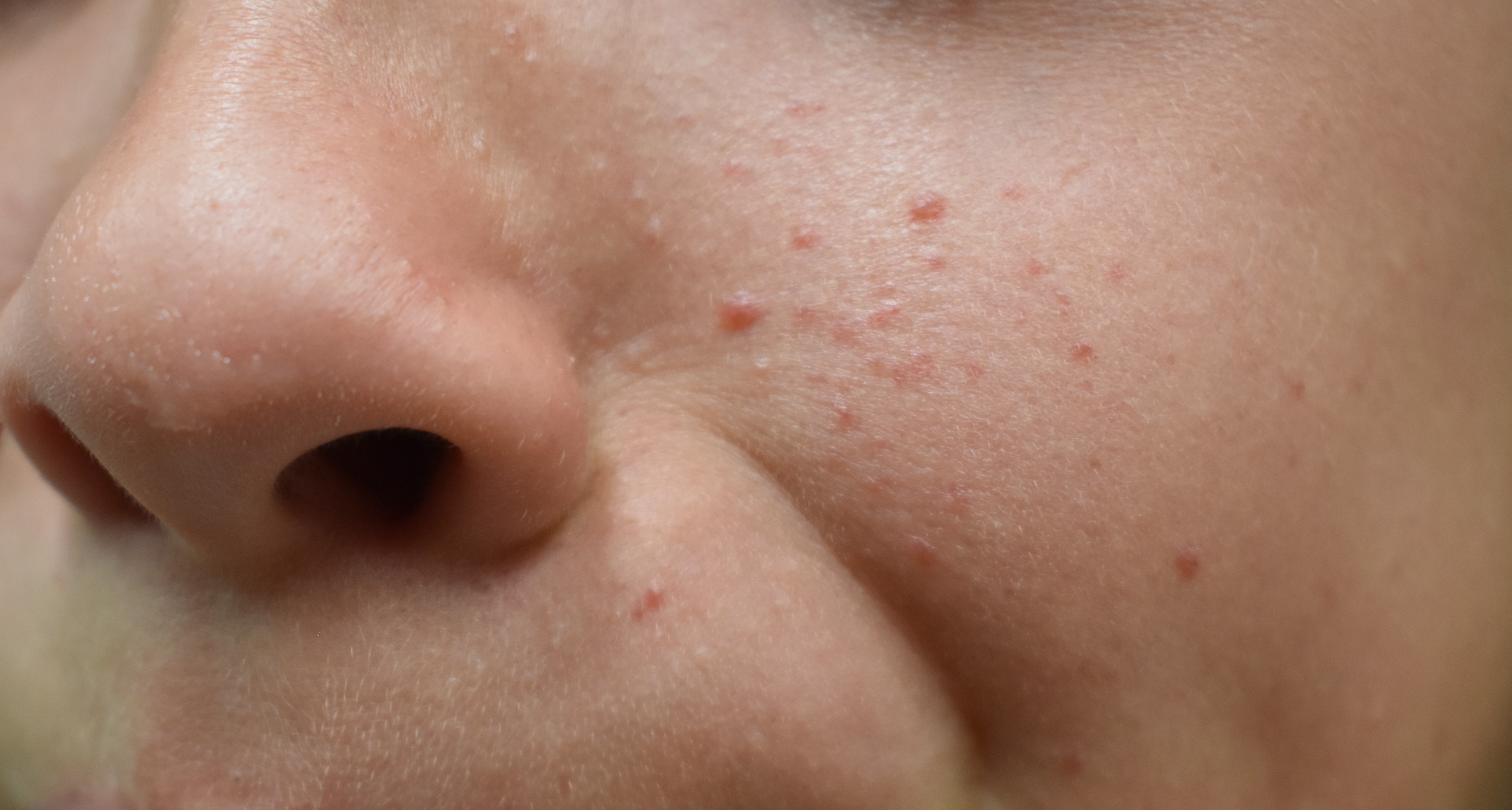 Tuberous Sclerosis 2a