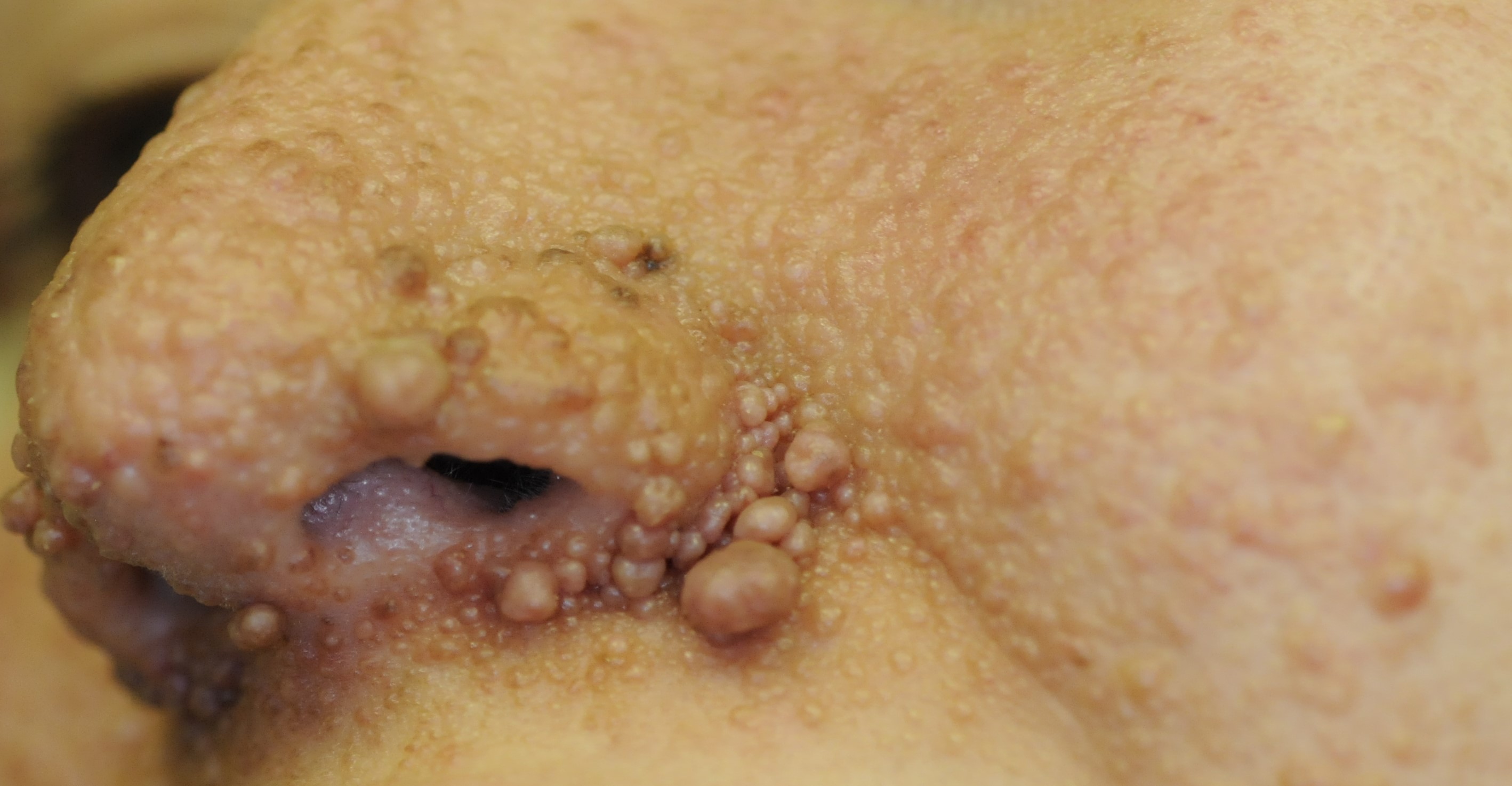 Tuberous Sclerosis