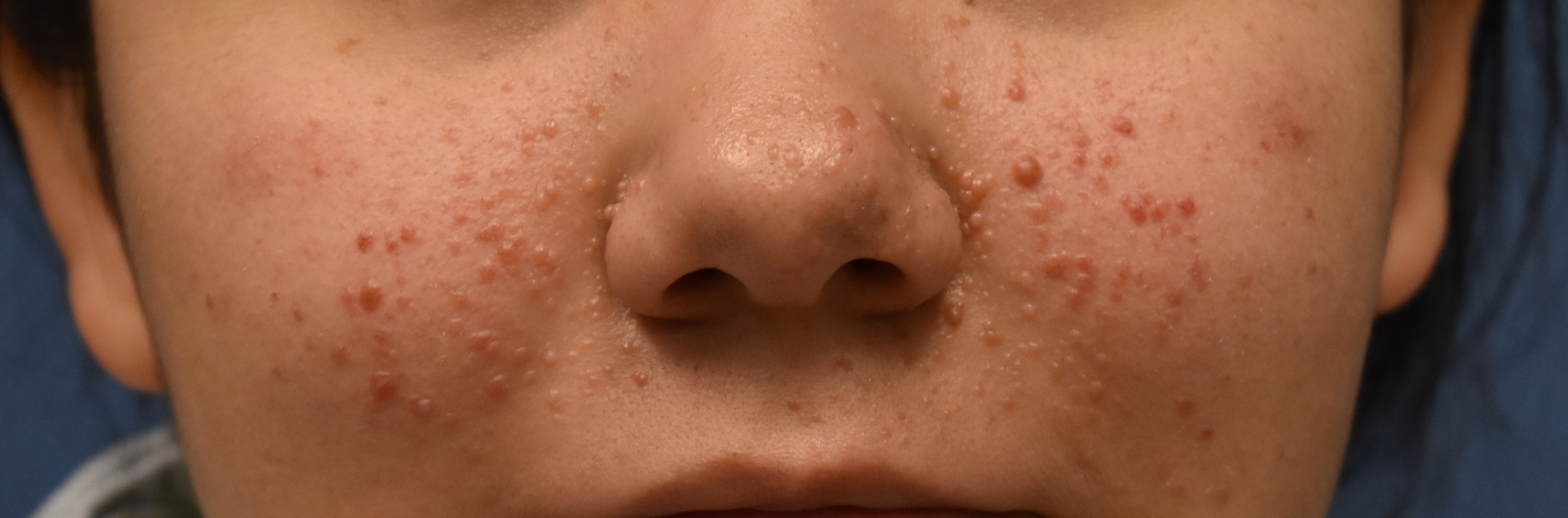 Tuberous Sclerosis 4a